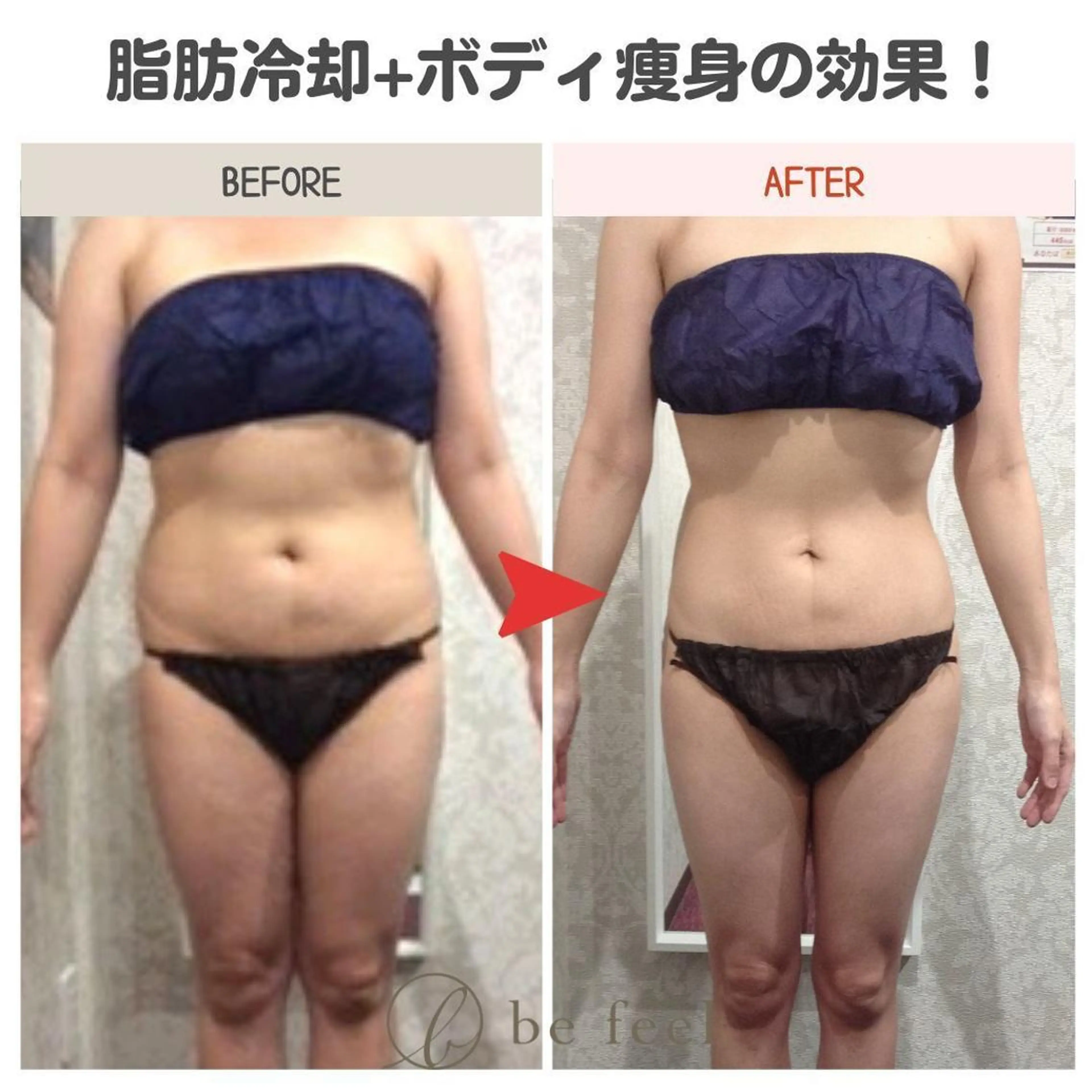 迷った方はコレ👍オーダーメイド痩身💖♪あなたにあわせた痩身プランでしっかり結果を出します😁☆平日限定3980円の写真