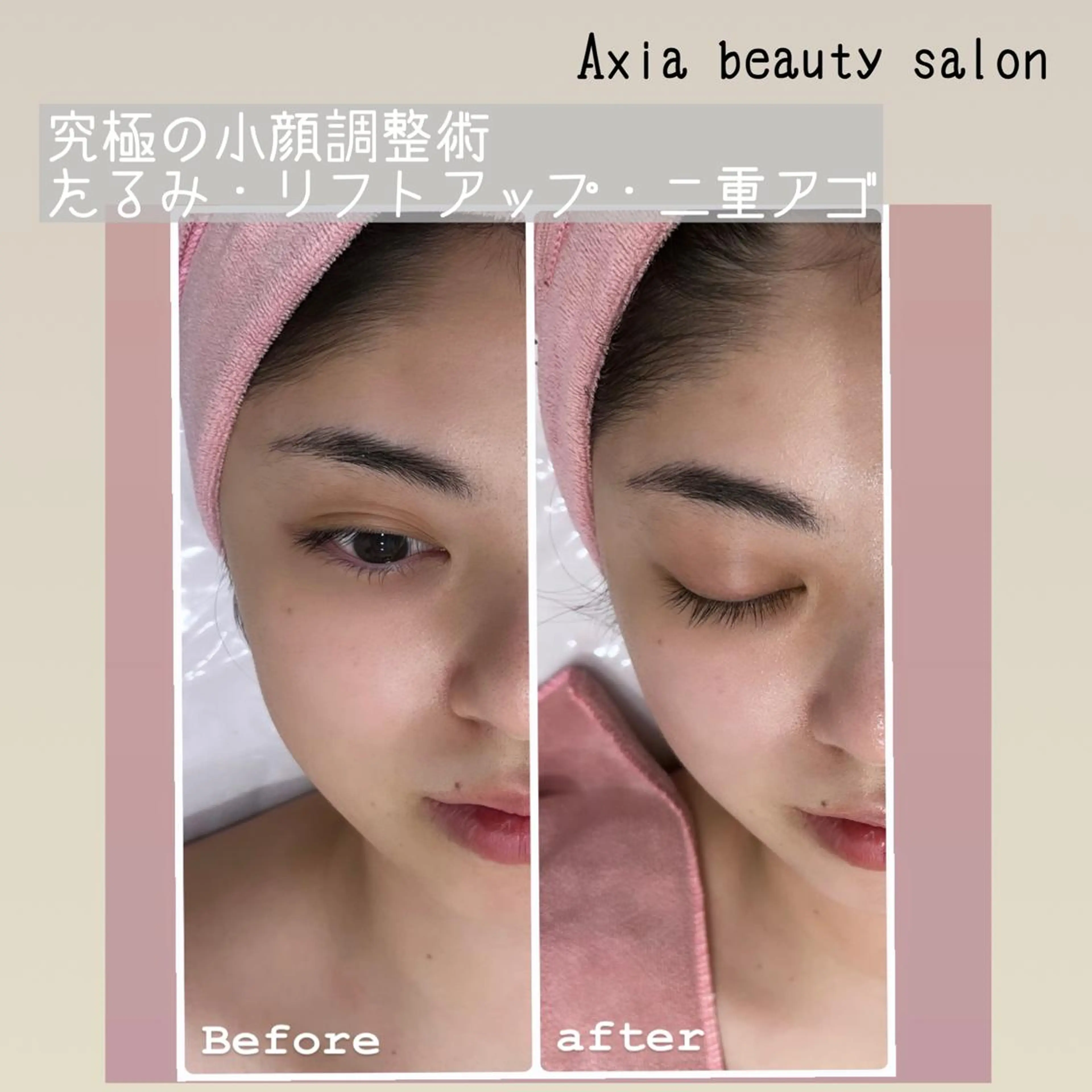 究極の小顔調整術【立体小顔】❣️顔の歪みを整えて立体感のあるバランスのとれたお顔をつくりますの写真