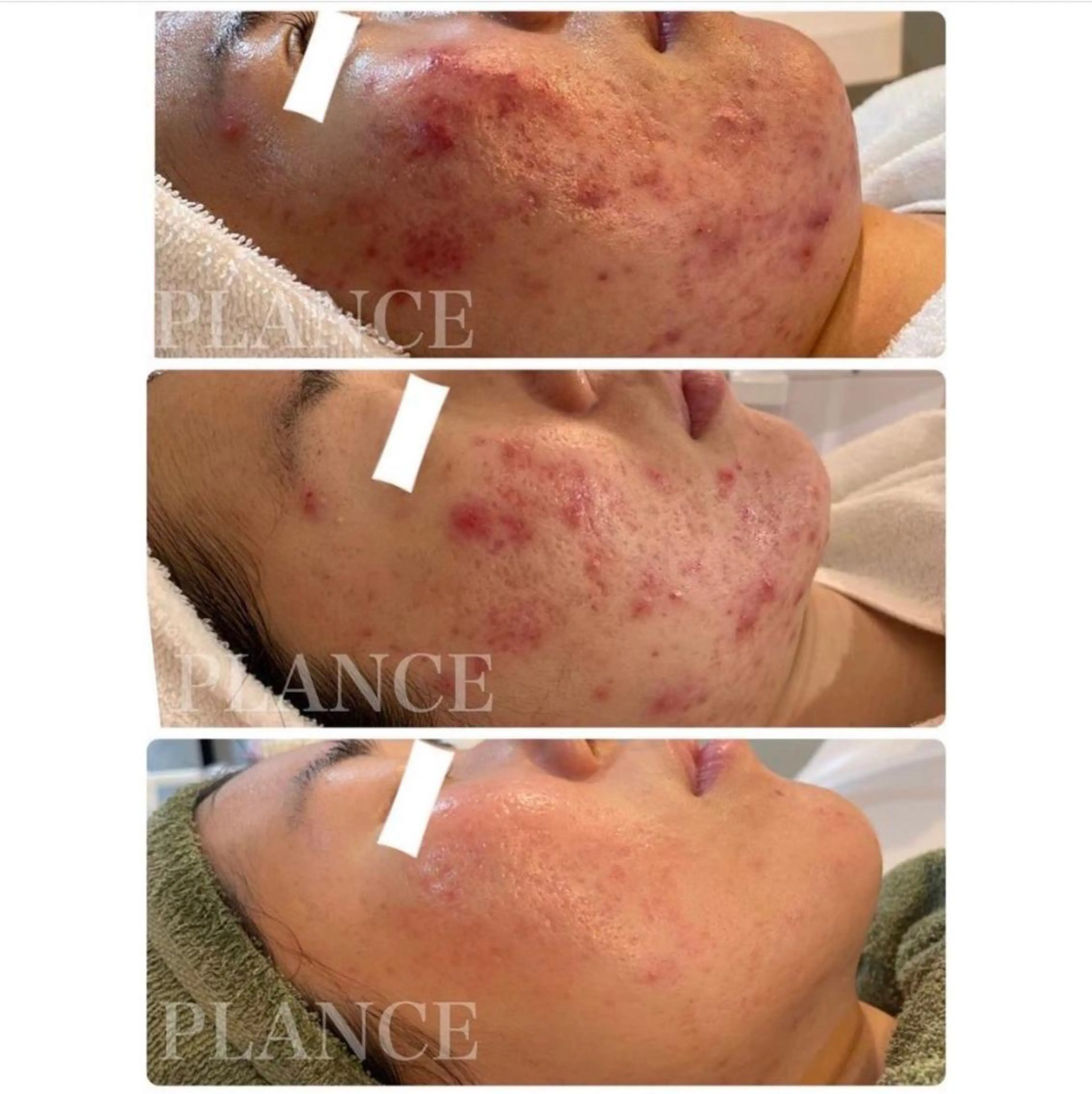 その他 フェイシャル専門 肌質改善/プランスのエステ・リラクイメージ