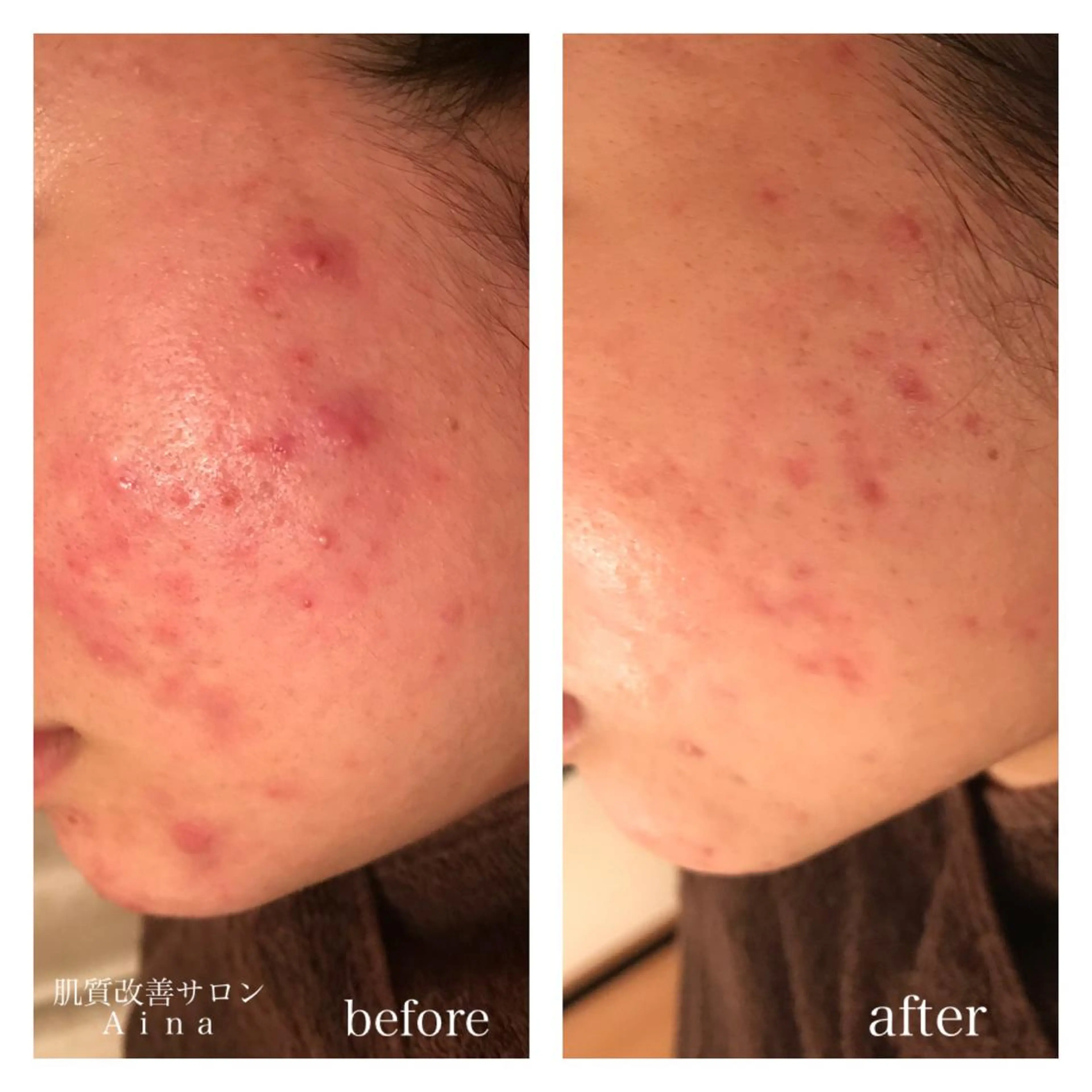 セミロング カラー パーマ ヘアアレンジ メンズ キッズ ネイル マツエク・マツパ 卒業式のヘアスタイル 卒業式 エステ リラク ニキビ跡専門サロン Ａｉｎａのエステ・リラクイメージ