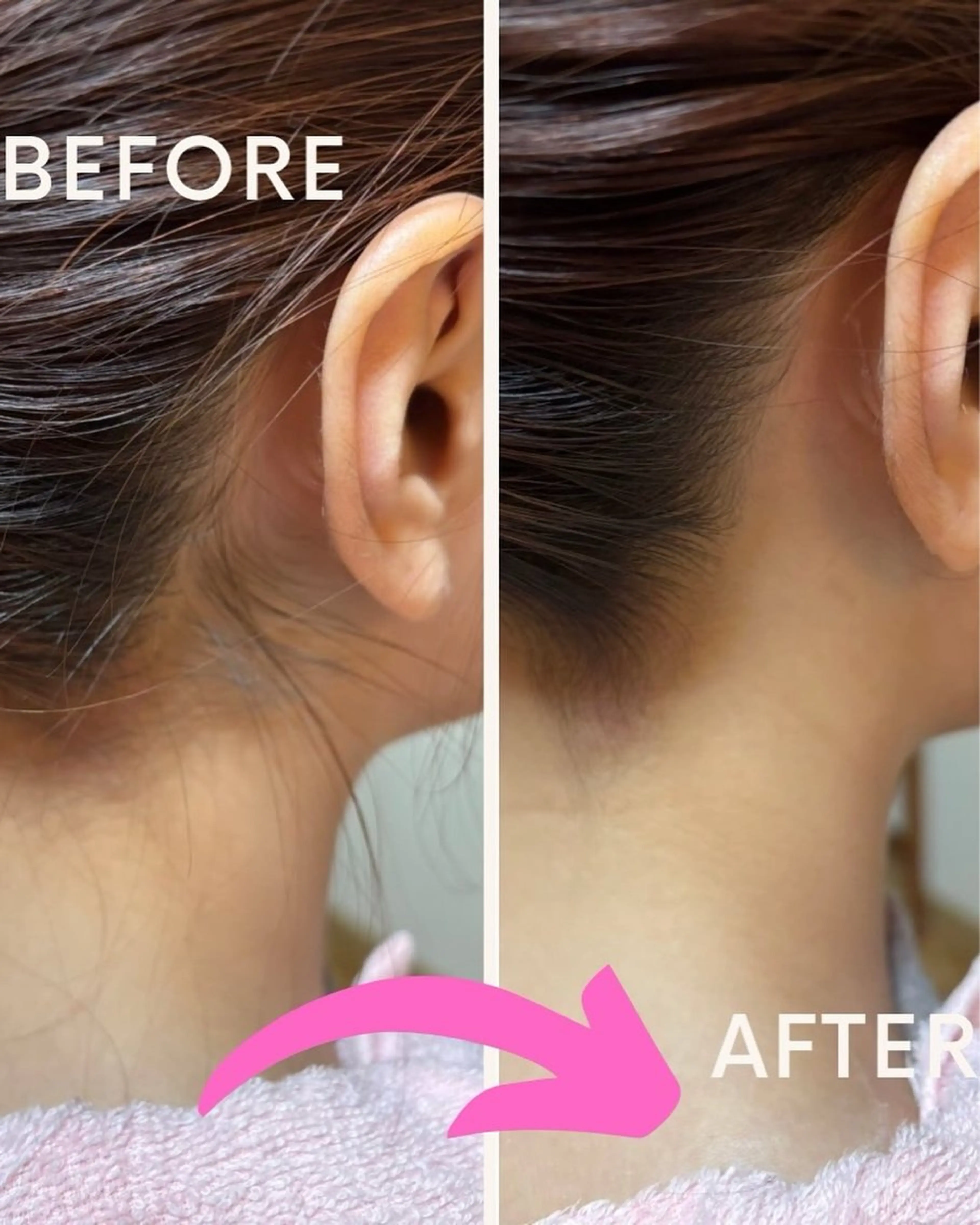 うなじ&襟足シェービング　成人や、脱毛前の形作りに！の写真