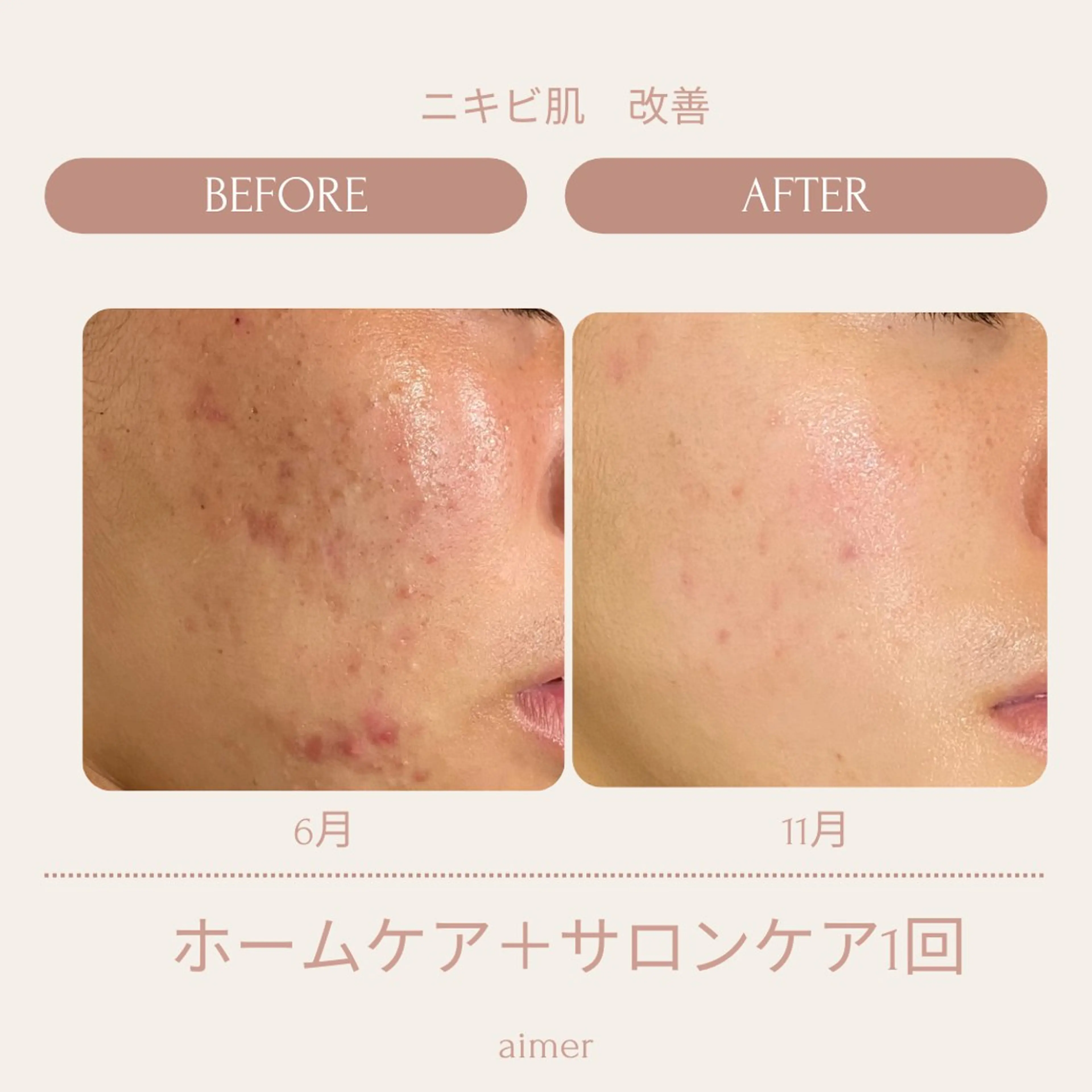 ニキビ肌、跡、ニキビレス“細胞活性機械”セルサーコース＊新規様限定＊女性専用＊マッサージ付き＊初回限定価格の写真