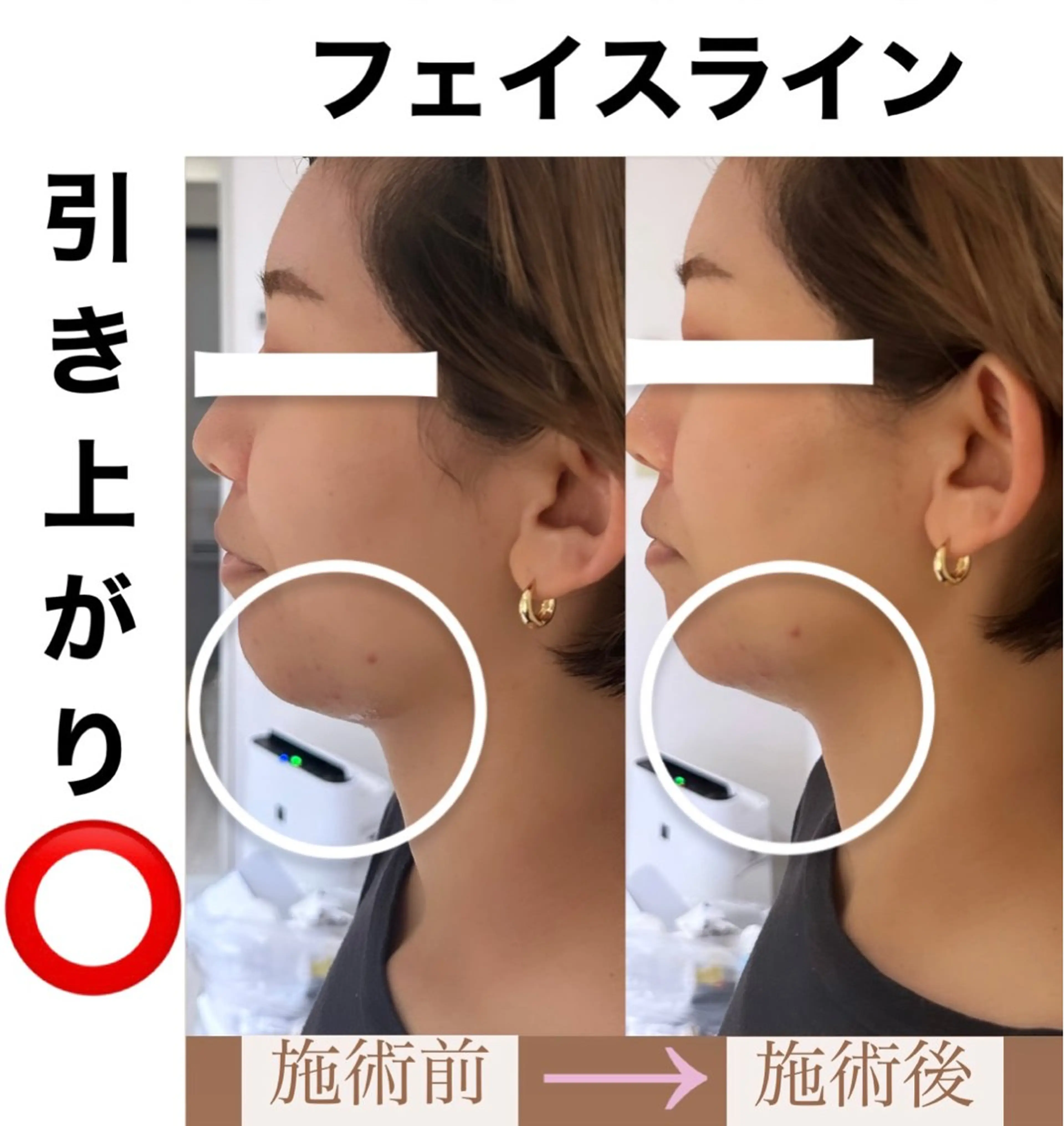 【産毛ケア&保湿対策ケア】顔脱毛&エレクトロポレーション　¥6,000→¥5,000の写真