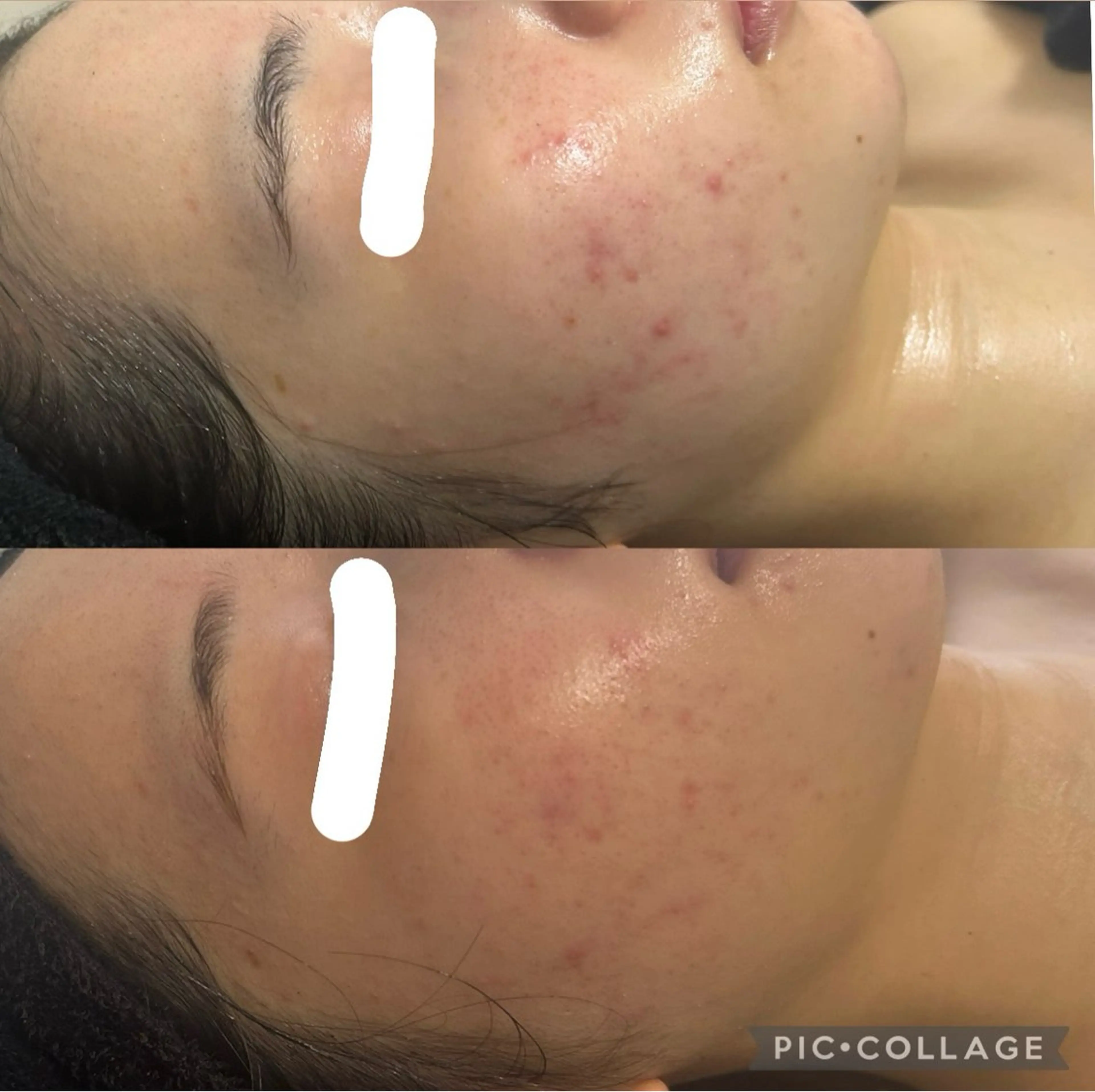 【学割U24】部分REVIハーブピーリング+たっぷり全顔炭酸ガスパック(芸能人多数愛用)💖の写真