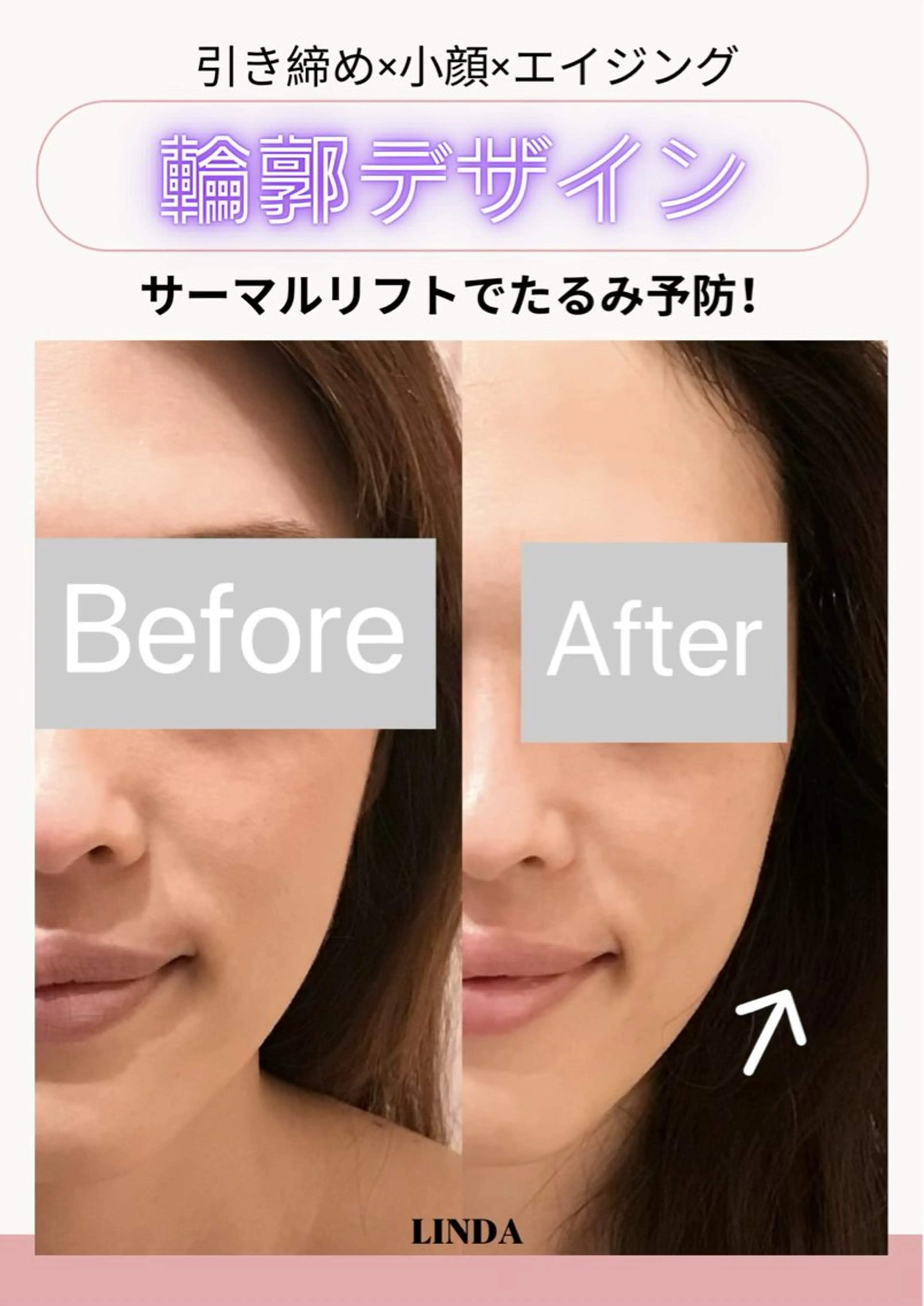 エステ 小顔&毛穴・肌質改善 LINDA西宮 AIのエステ・リラクイメージ