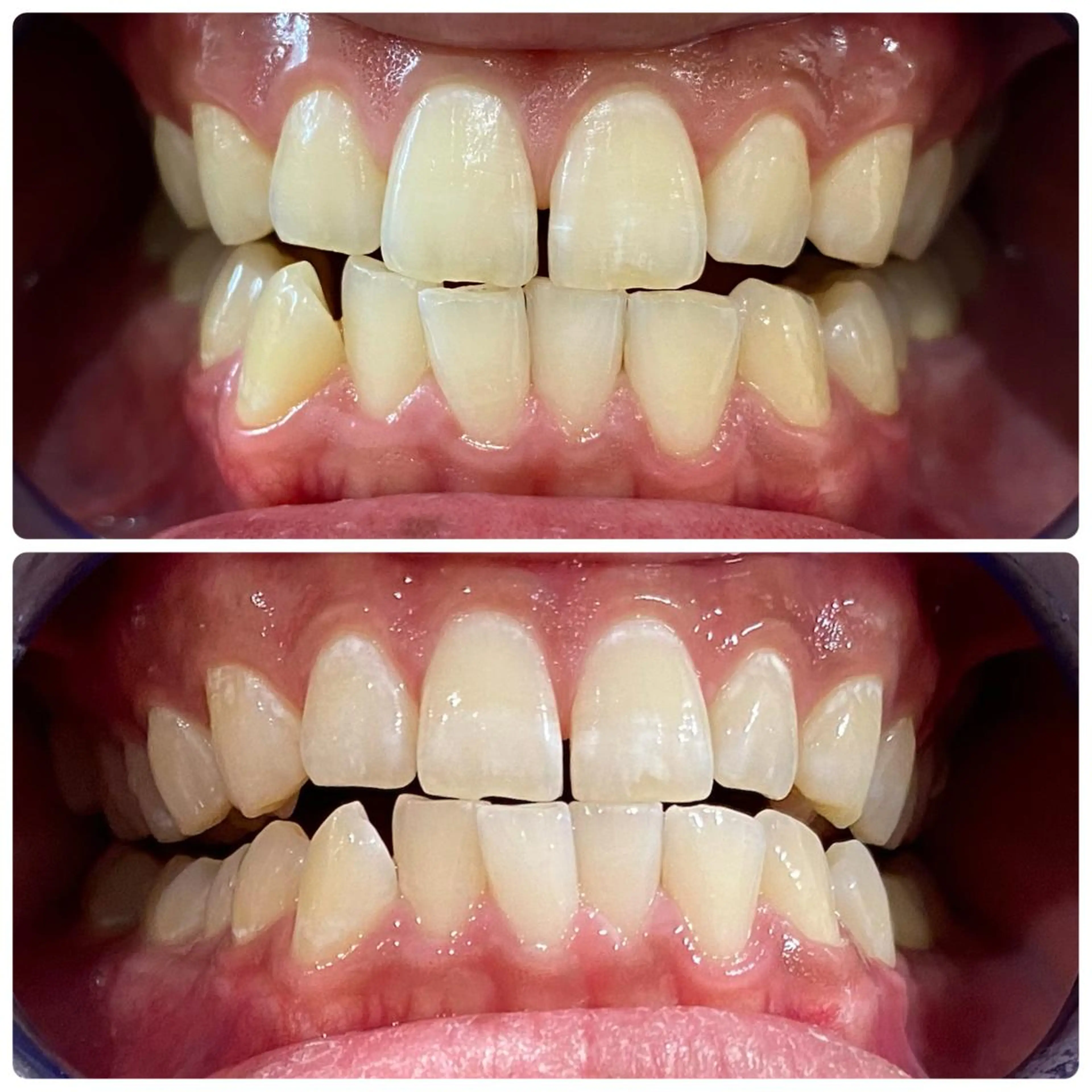 その他 セルフホワイトニング 🦷口元垢抜け✨のその他イメージ