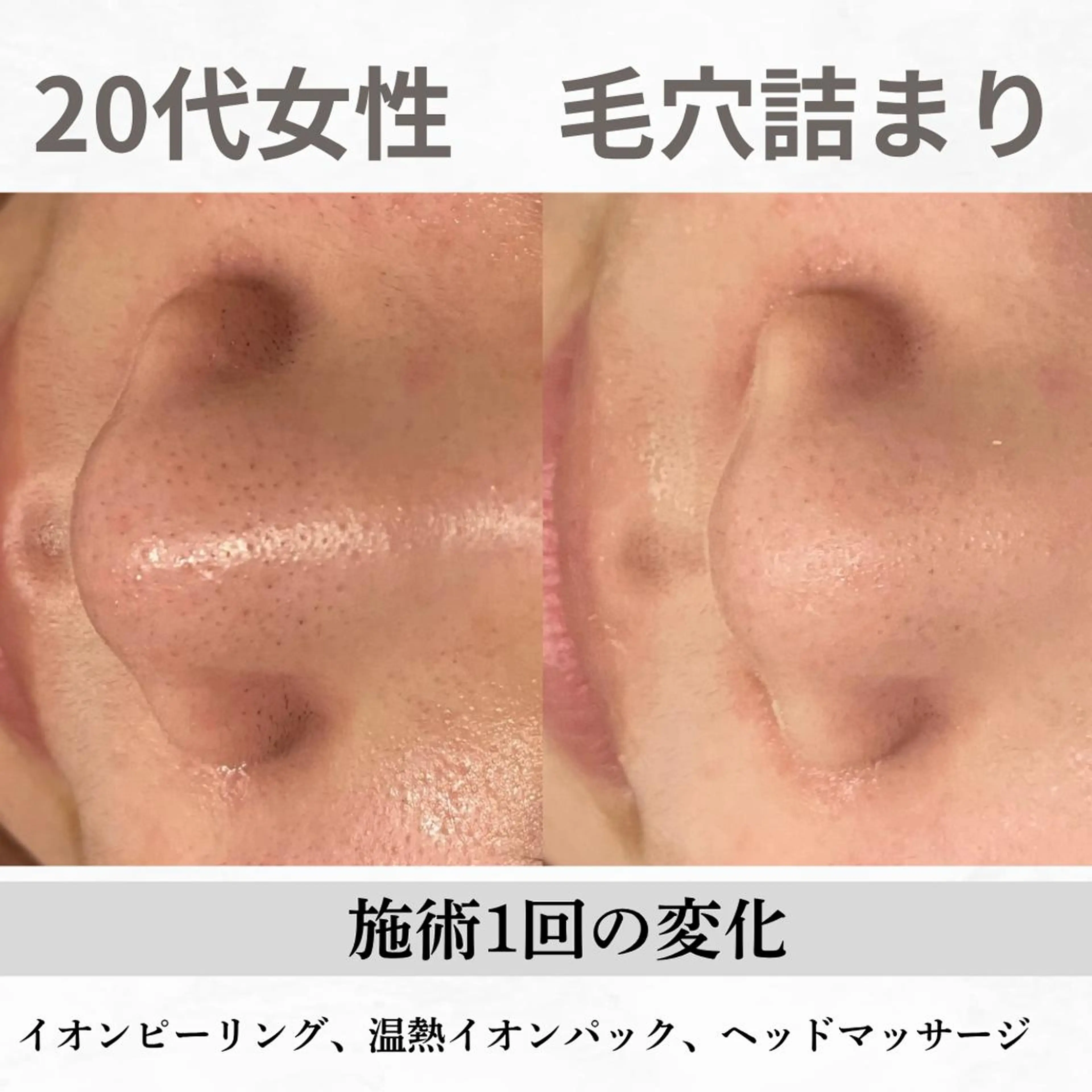 重度ニキビ専門🌷 ダウンタイムなしのエステ・リラクイメージ