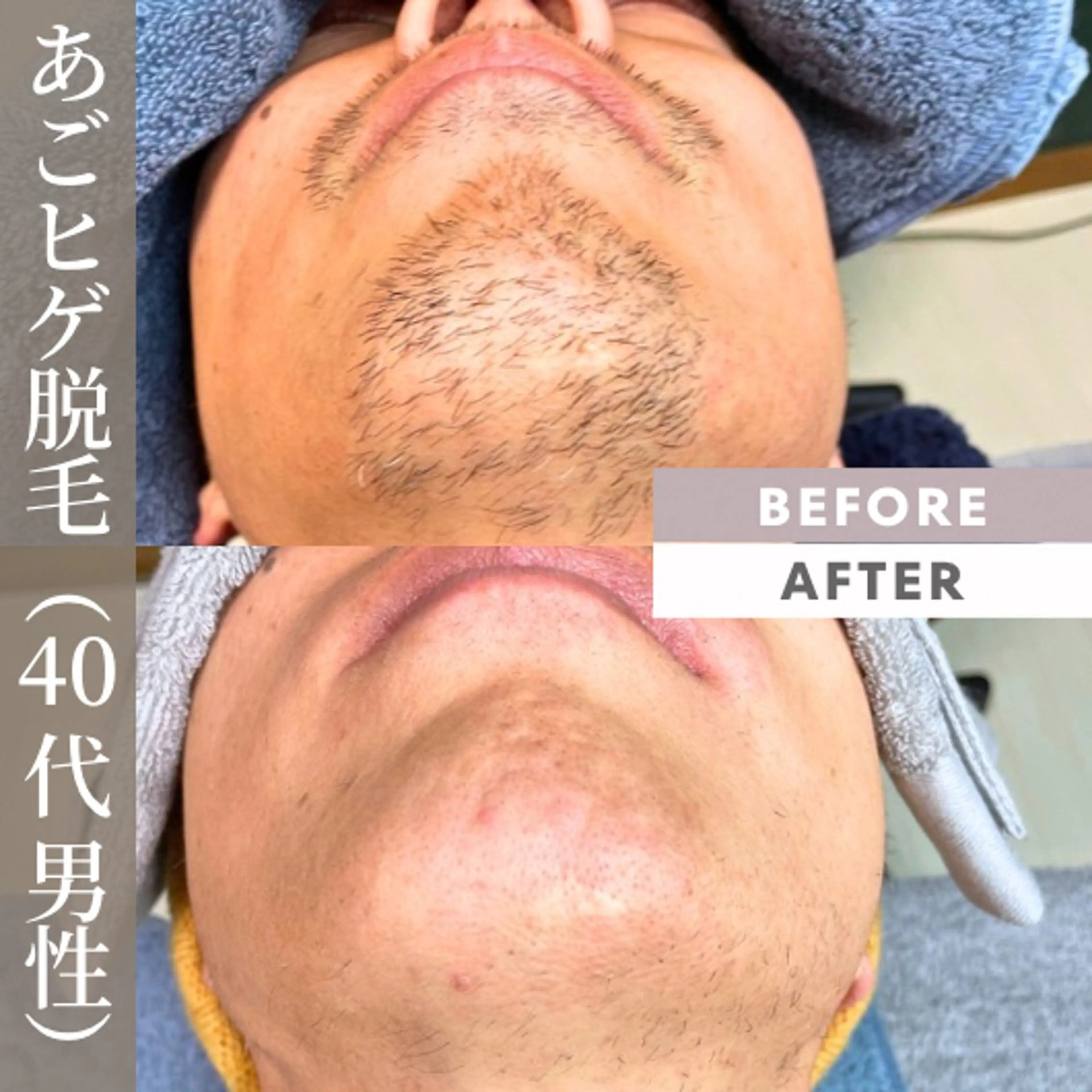 メンズ 脱毛 【一本ずつ脱毛】 ReMove 柏のエステ・リラクイメージ