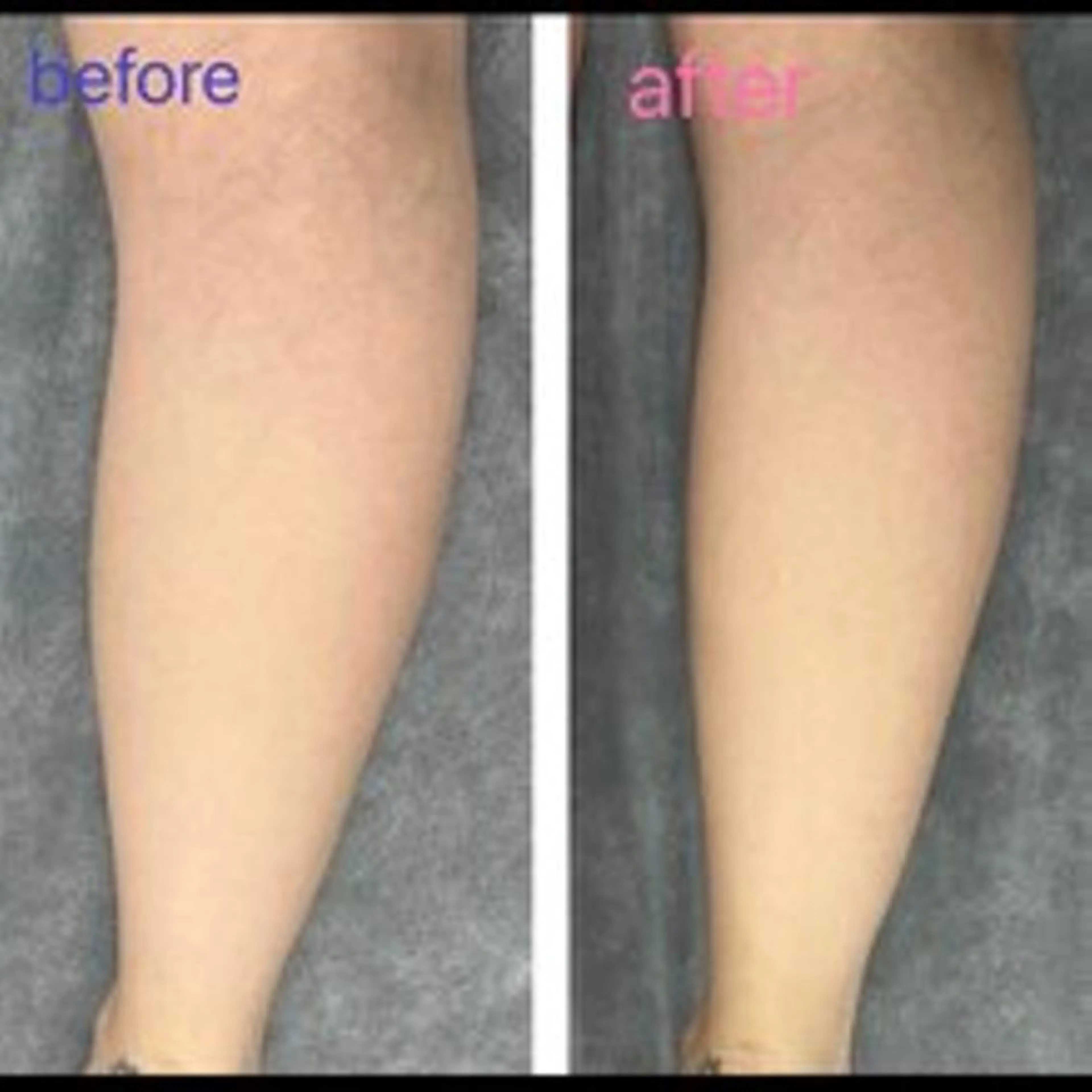 ハーブピーリング ララピール 田中のその他イメージ