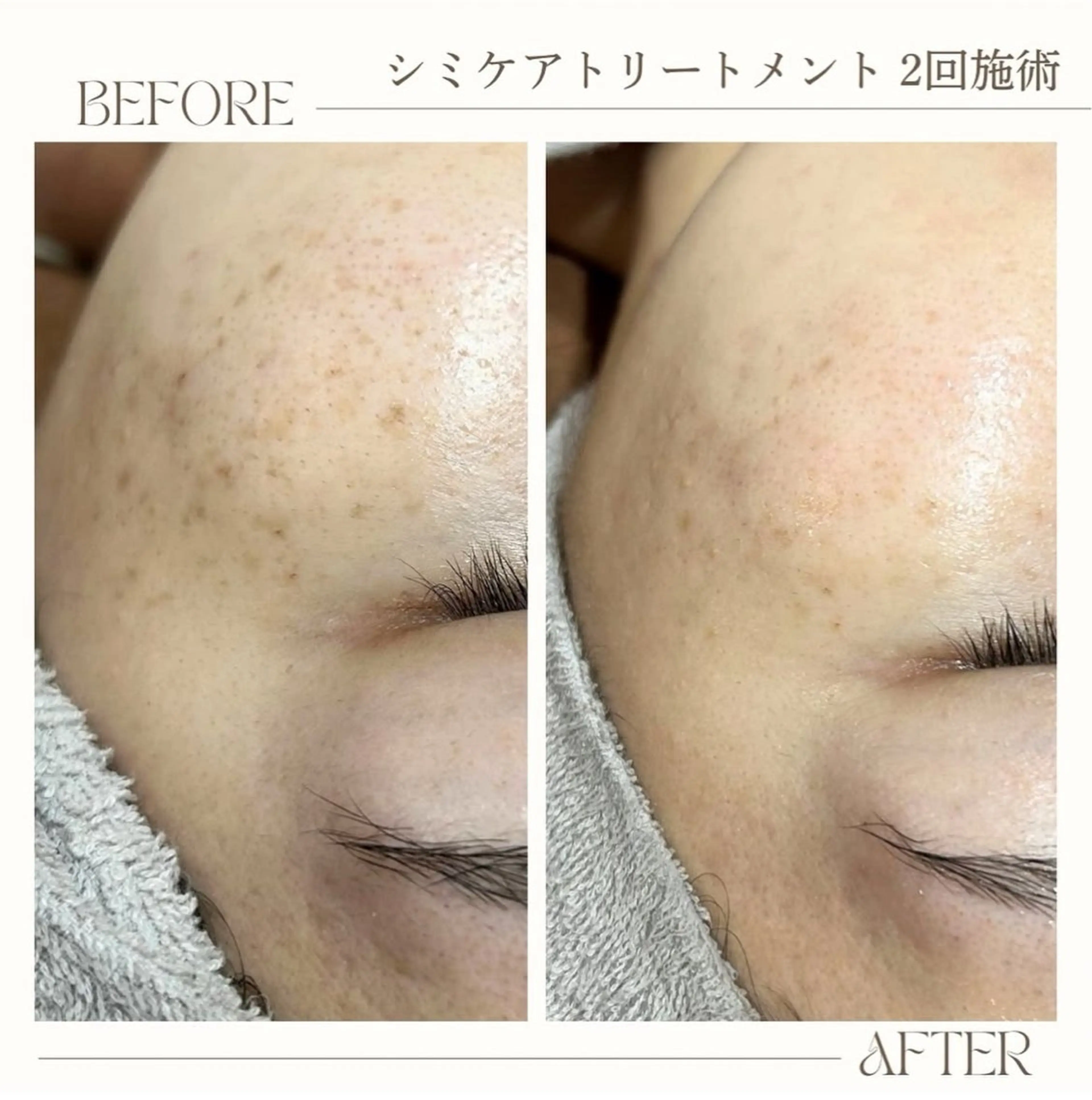 【お試しシミケア】シミケア30分の写真