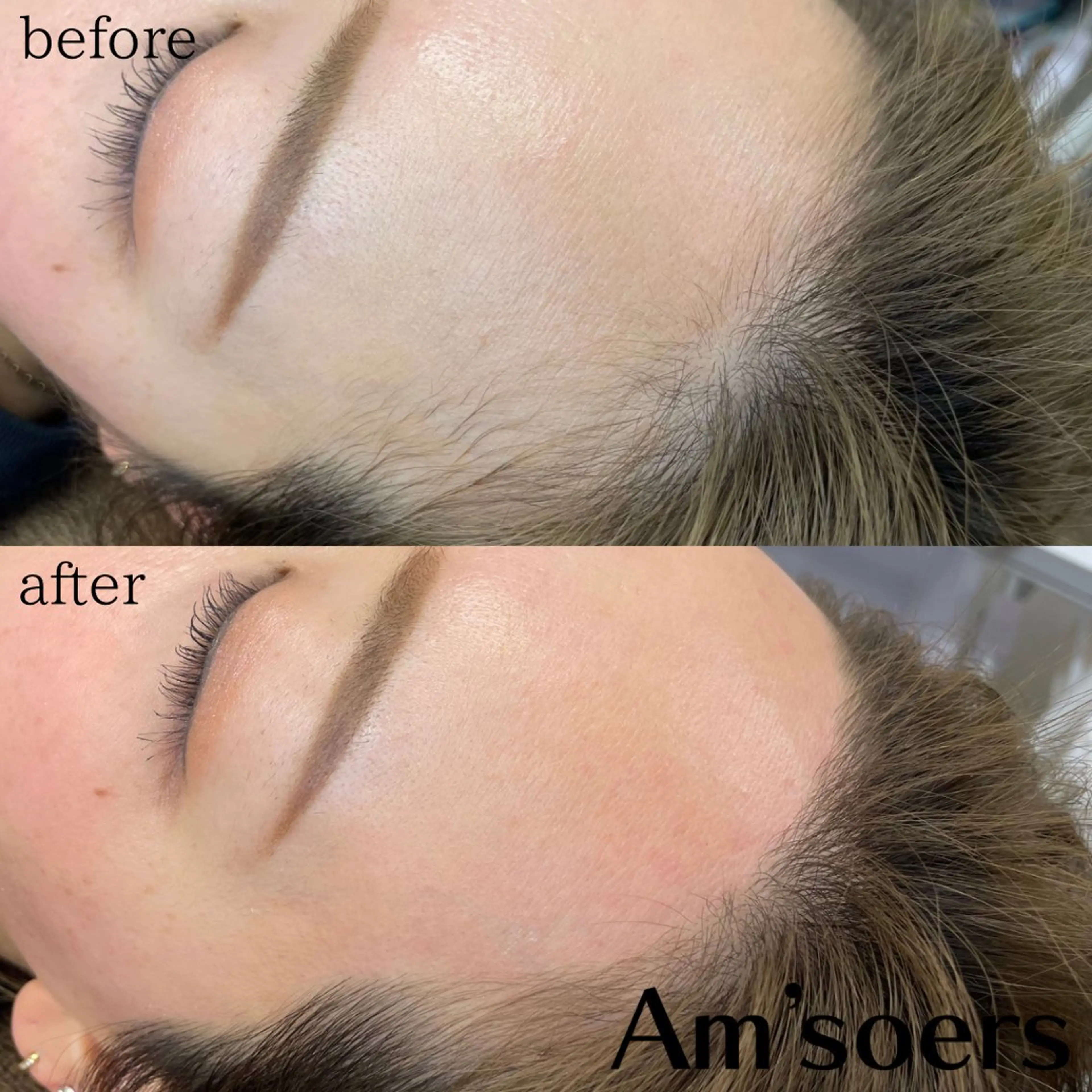 【フェイシャルワックス】角質・角栓・うぶ毛に💫ミニモ限定（通常7800円）の写真