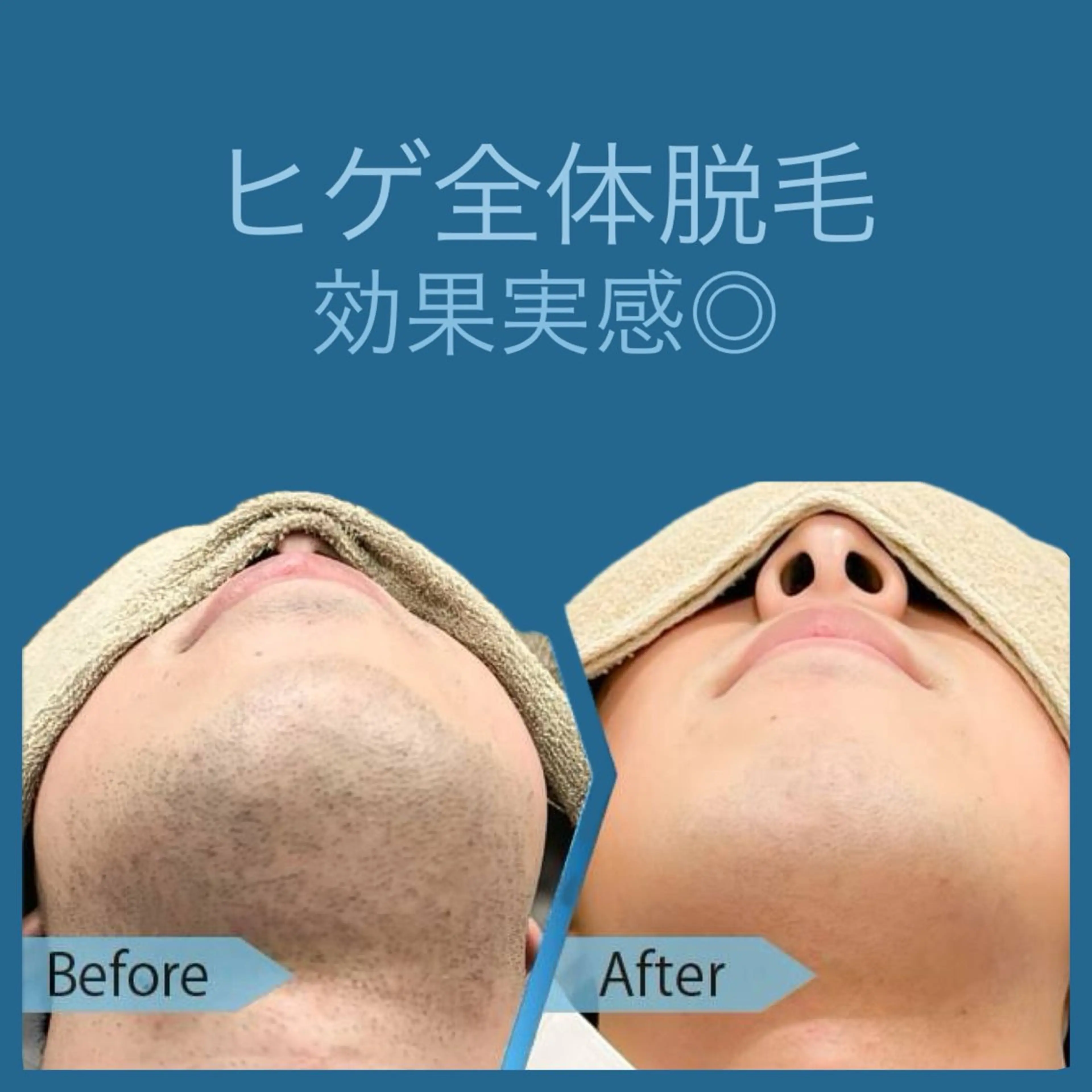 【最新脱毛器!パワー値MAX】 ヒゲ全体脱毛の写真