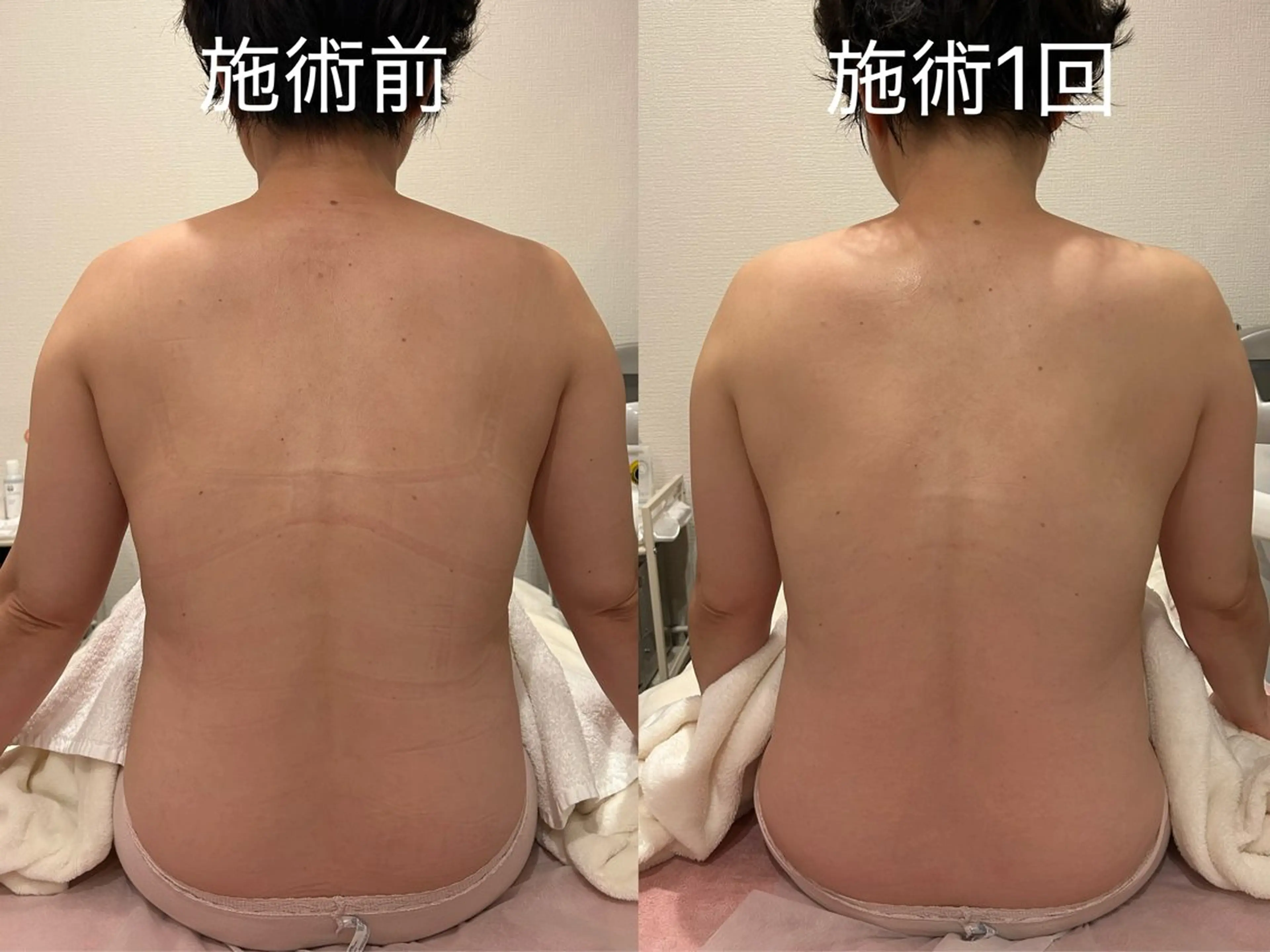 【デトックス痩身】リンパケア 60分（背面＆デコルテ）の写真