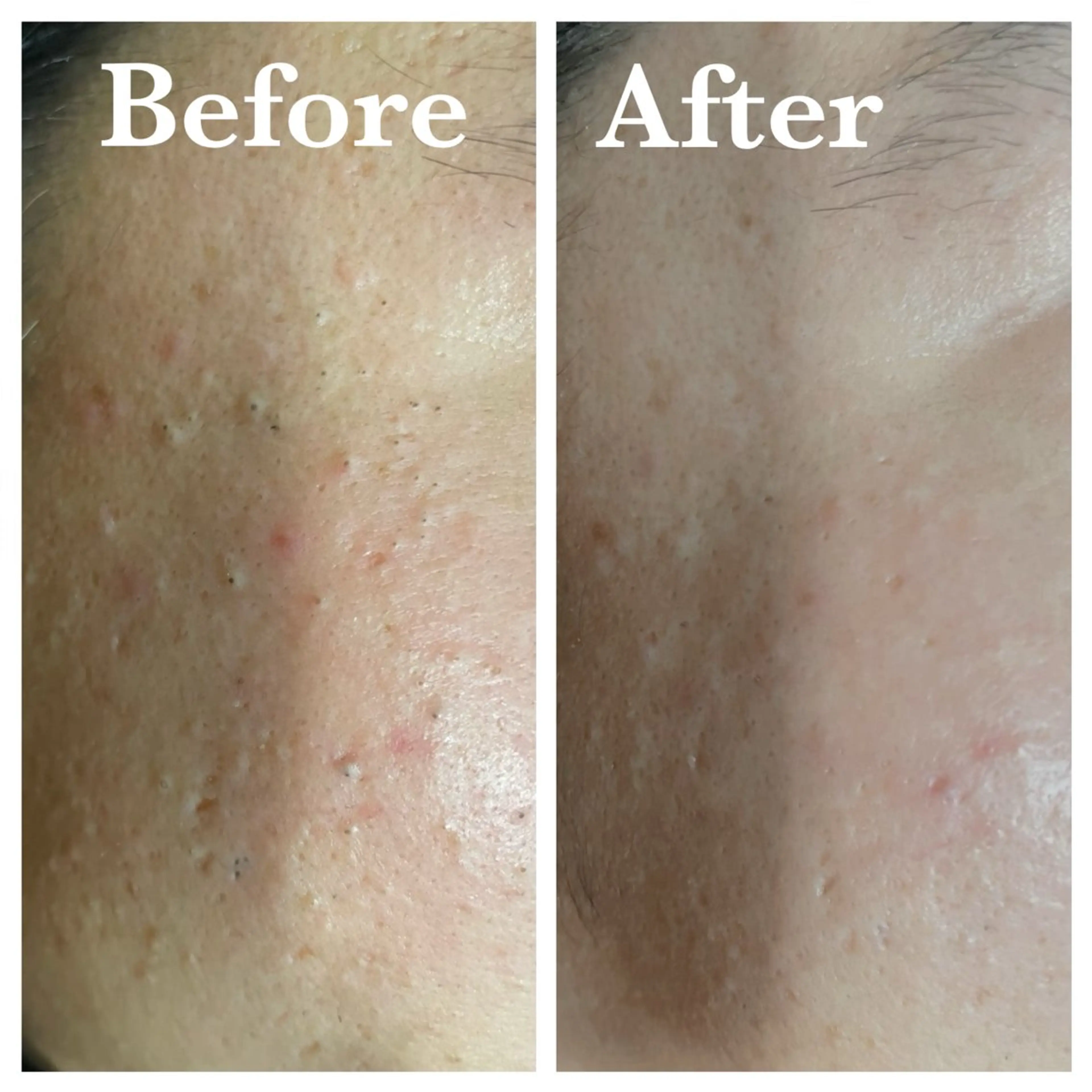 平日限定⭐️ピーリング毛穴エステ💆‍♂️の写真