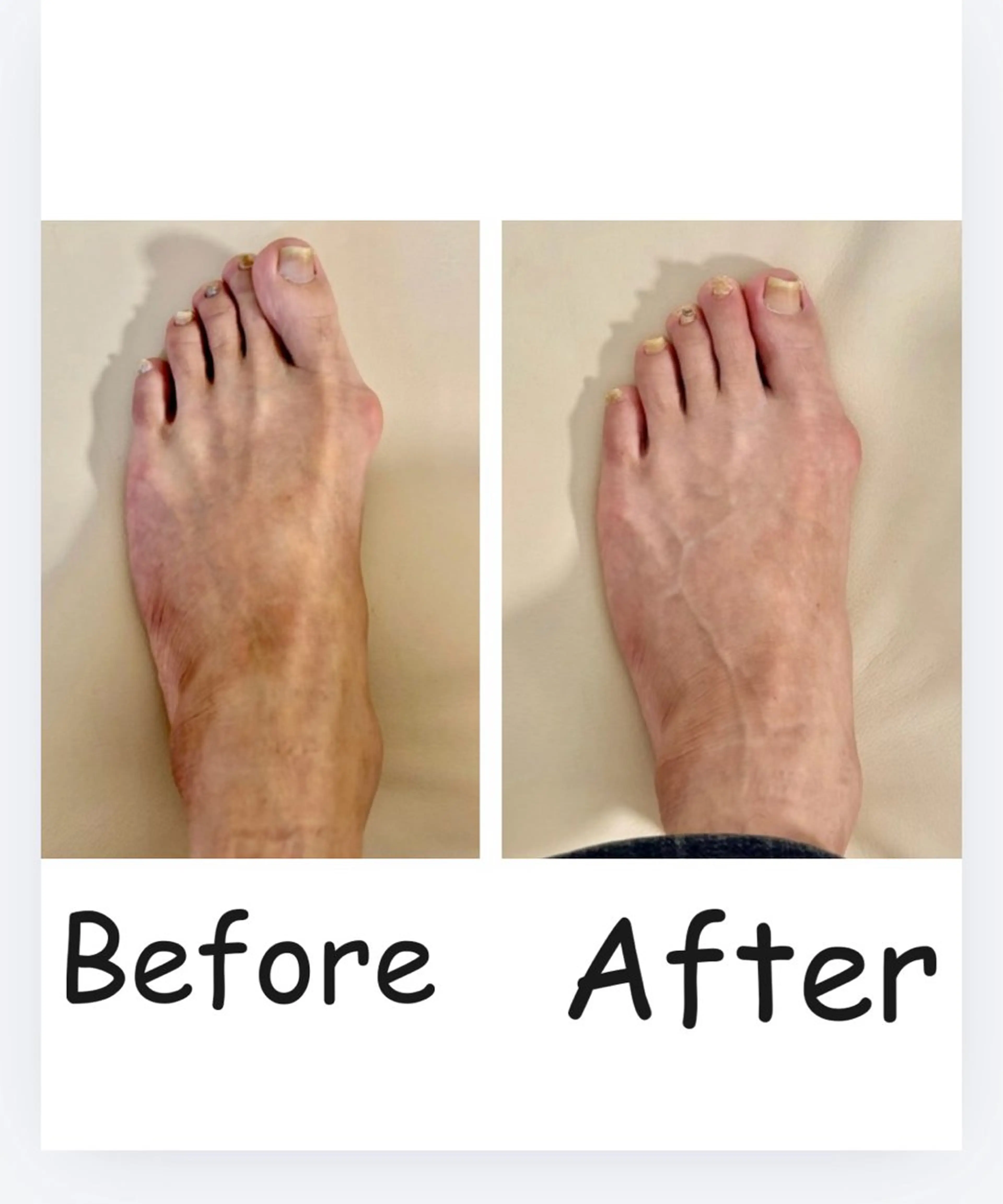 ５月キャンペーン7名様限定‼️外反母趾矯正の写真