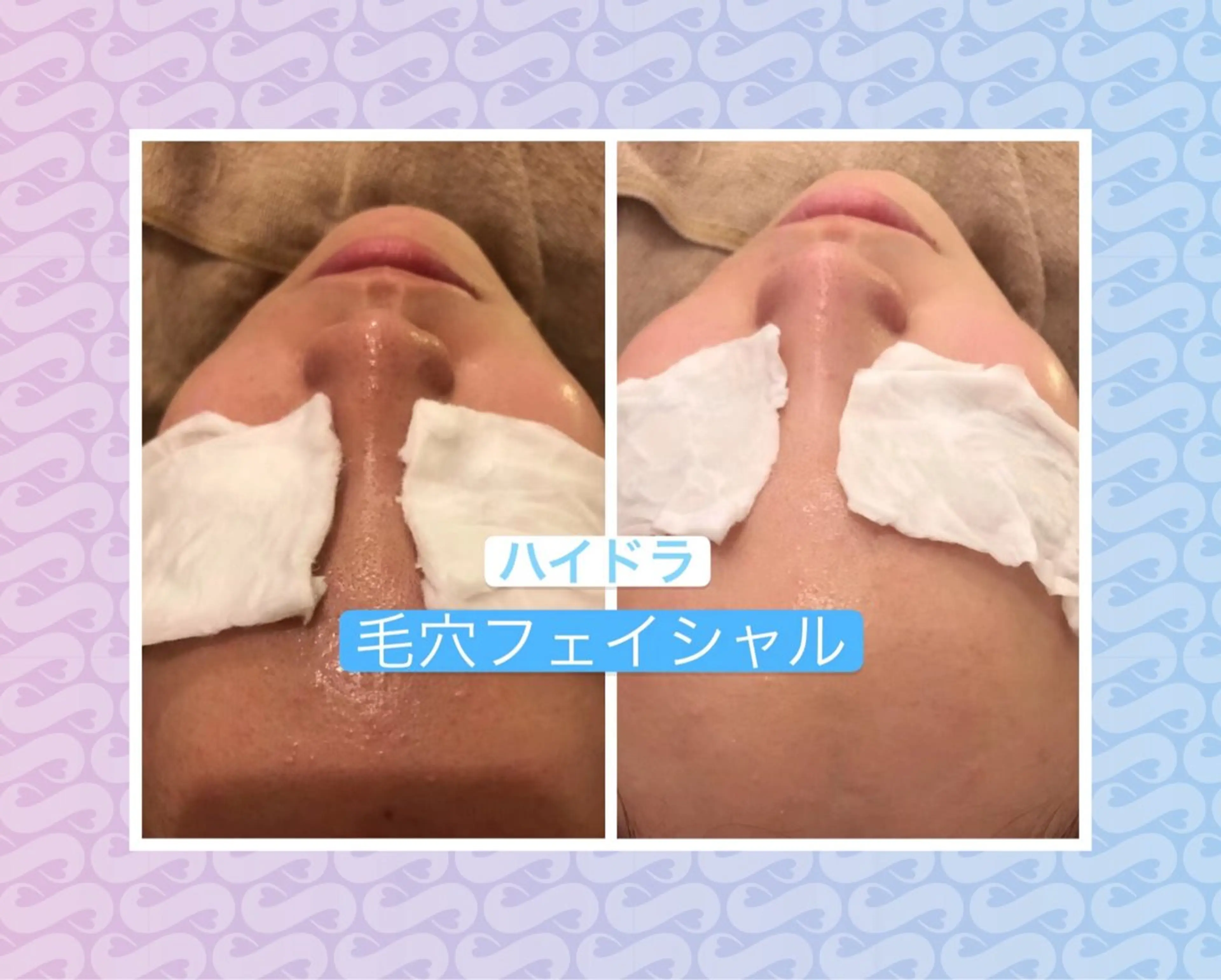 エステ リラク 毛穴洗浄& 睫毛パーマ上野御徒町のマツエク・マツパデザイン