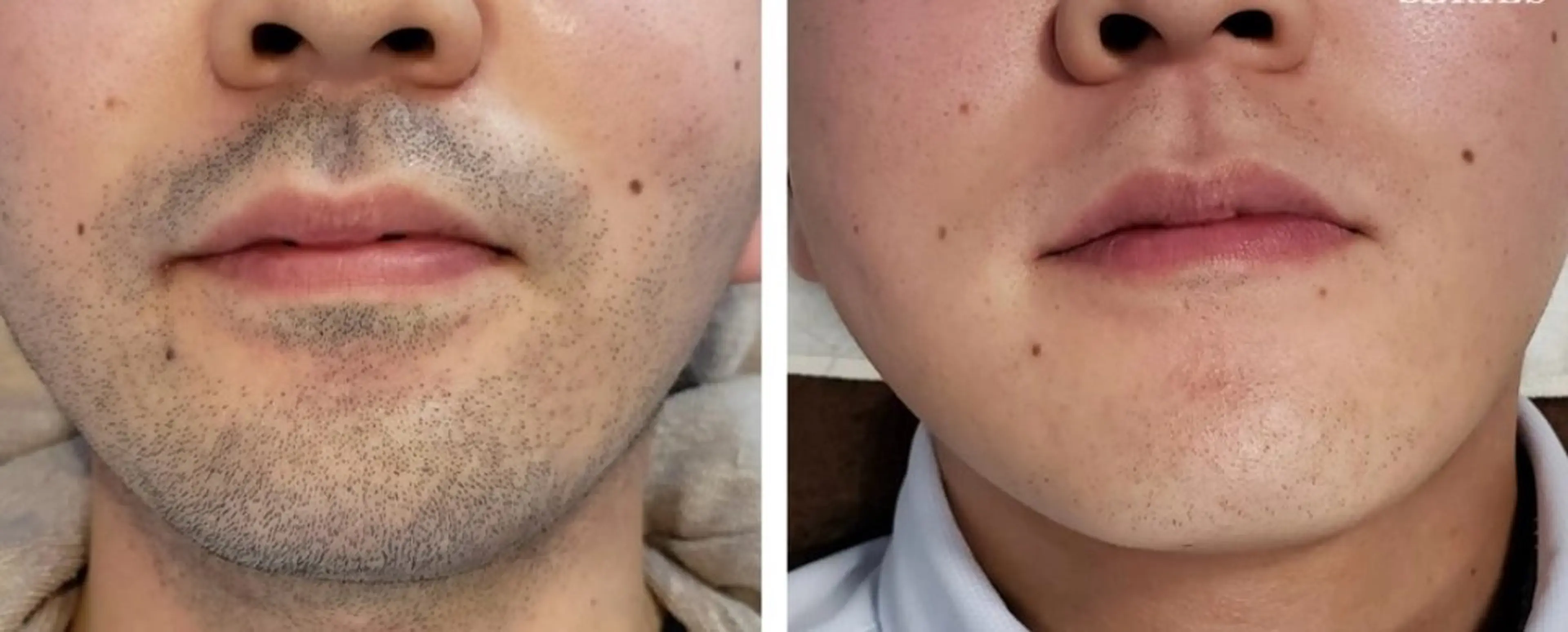 ミニモ限定価格◆メンズ美肌脱毛◆全身脱毛(顔・VIO込み)の写真