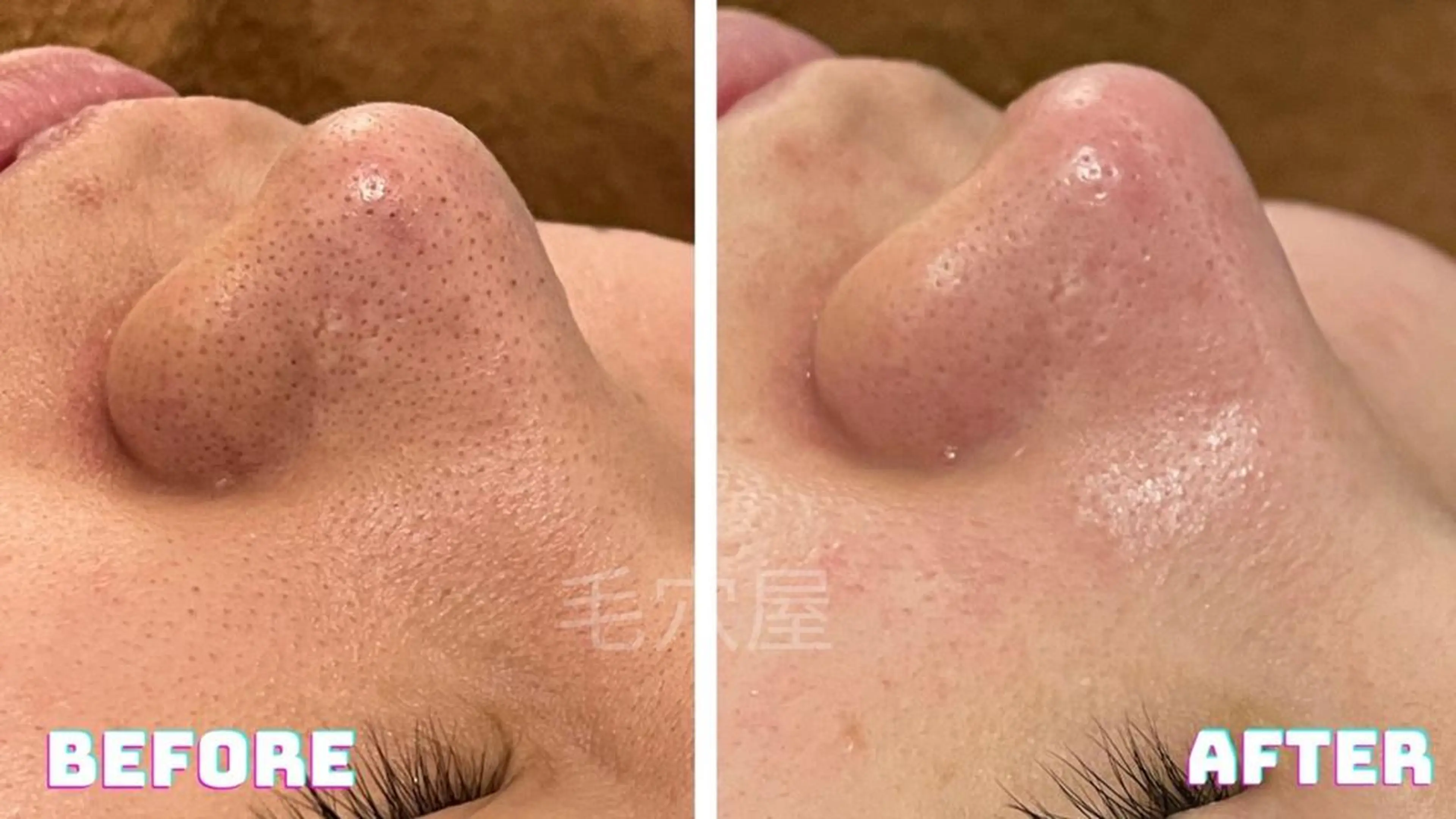 エステ 毛穴/毛穴洗浄専門 エミルカ船橋のエステ・リラクイメージ