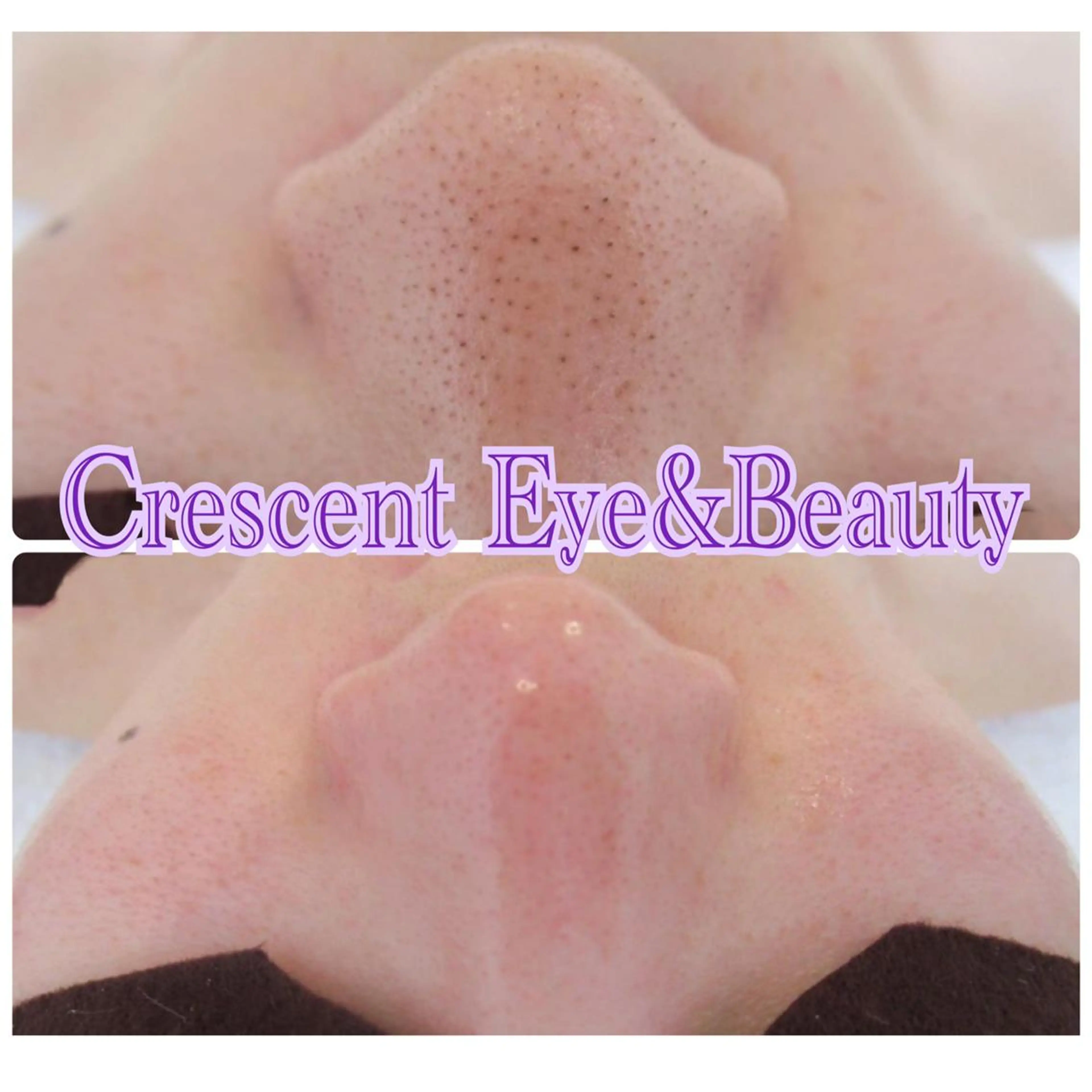 モニター様特別価格☆大人気毛穴エクストラクション9900円→5980円！！の写真