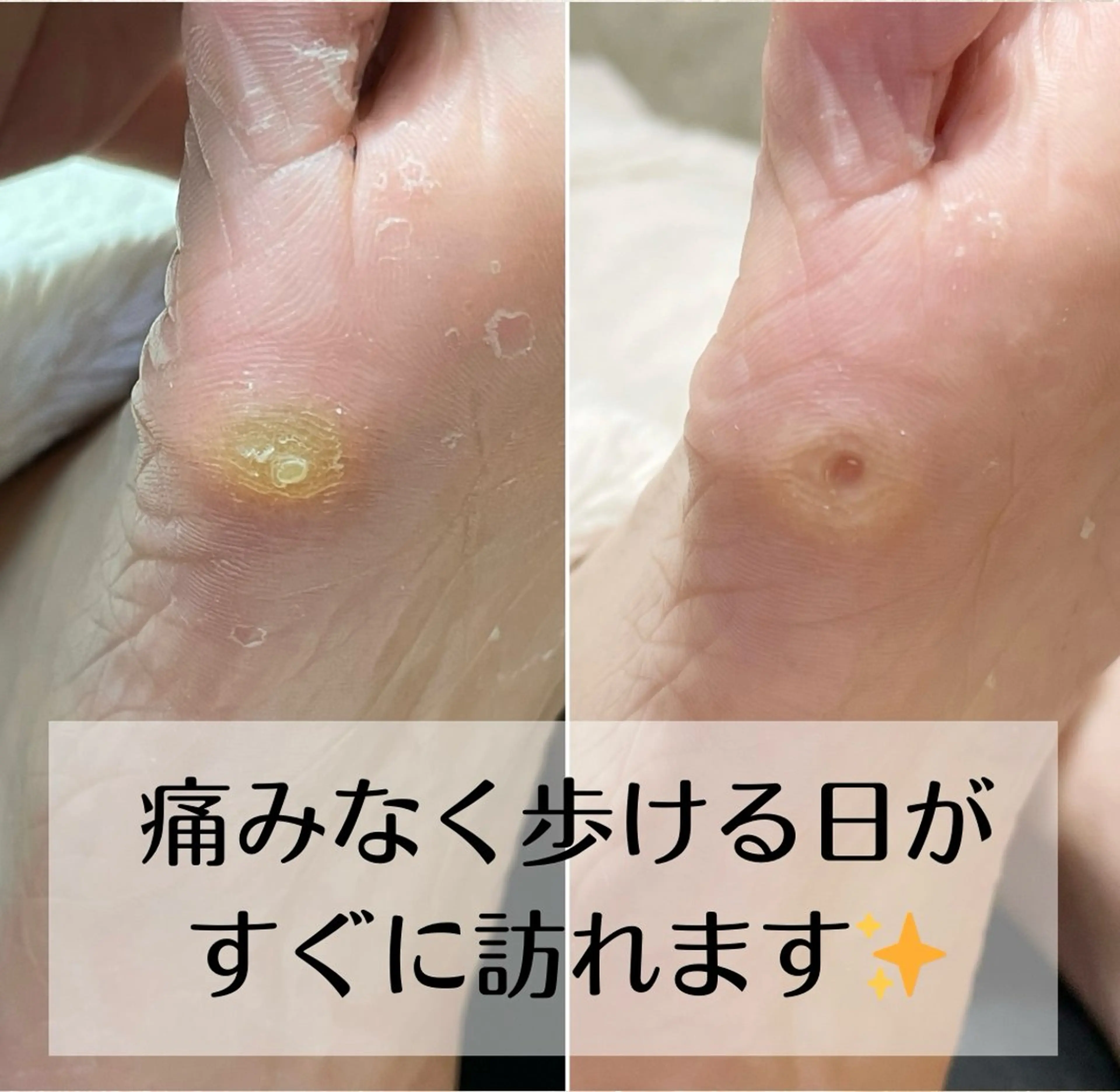 深爪・巻き爪 専門サンセリテのネイルデザイン