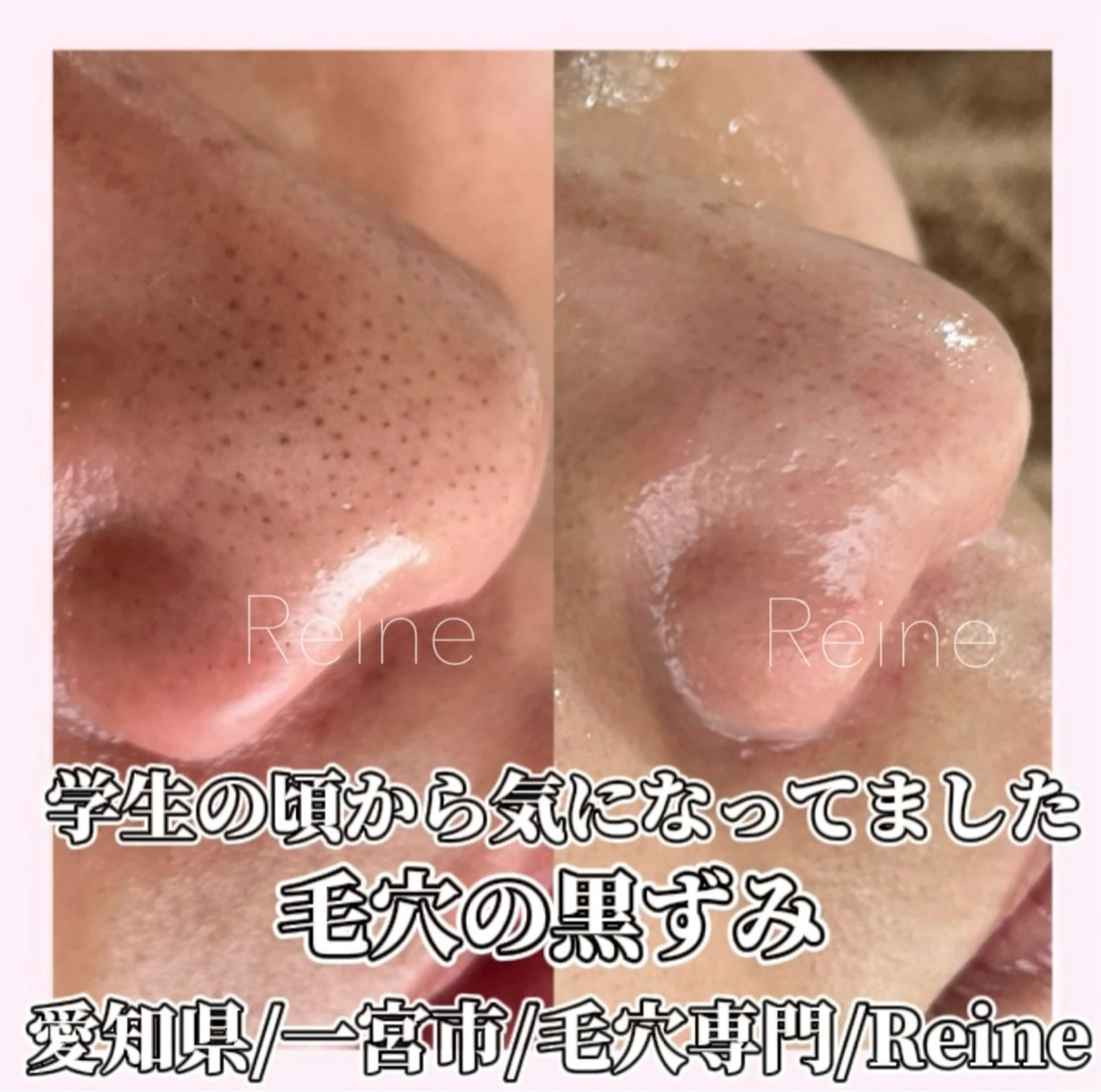 毛穴/シミ肝斑/脱毛 横山梨里のエステ・リラクイメージ