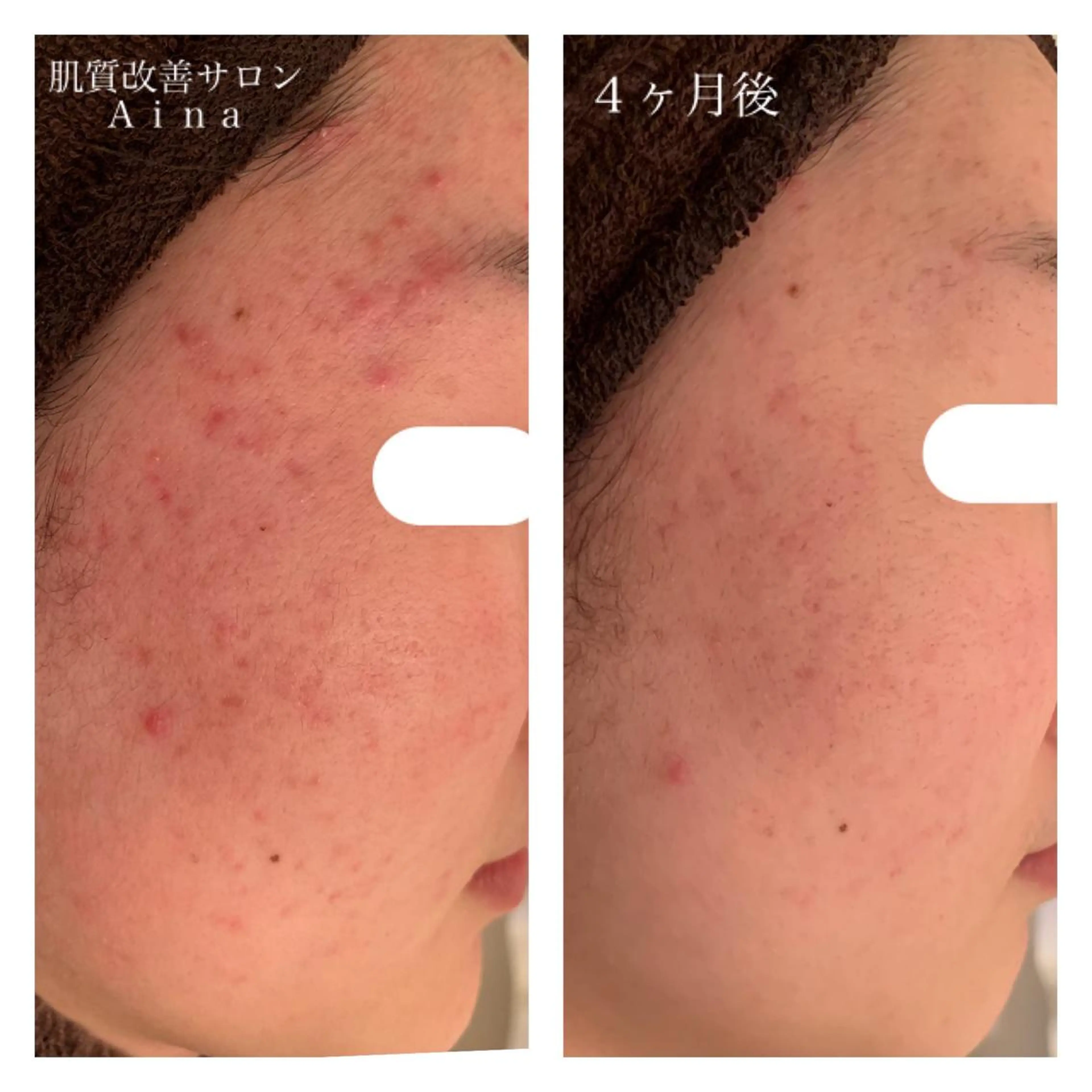 ミディアム カラー パーマ ヘアアレンジ メンズ キッズ ネイル マツエク・マツパ エステ リラク ニキビ跡専門サロン Ａｉｎａのエステ・リラクイメージ