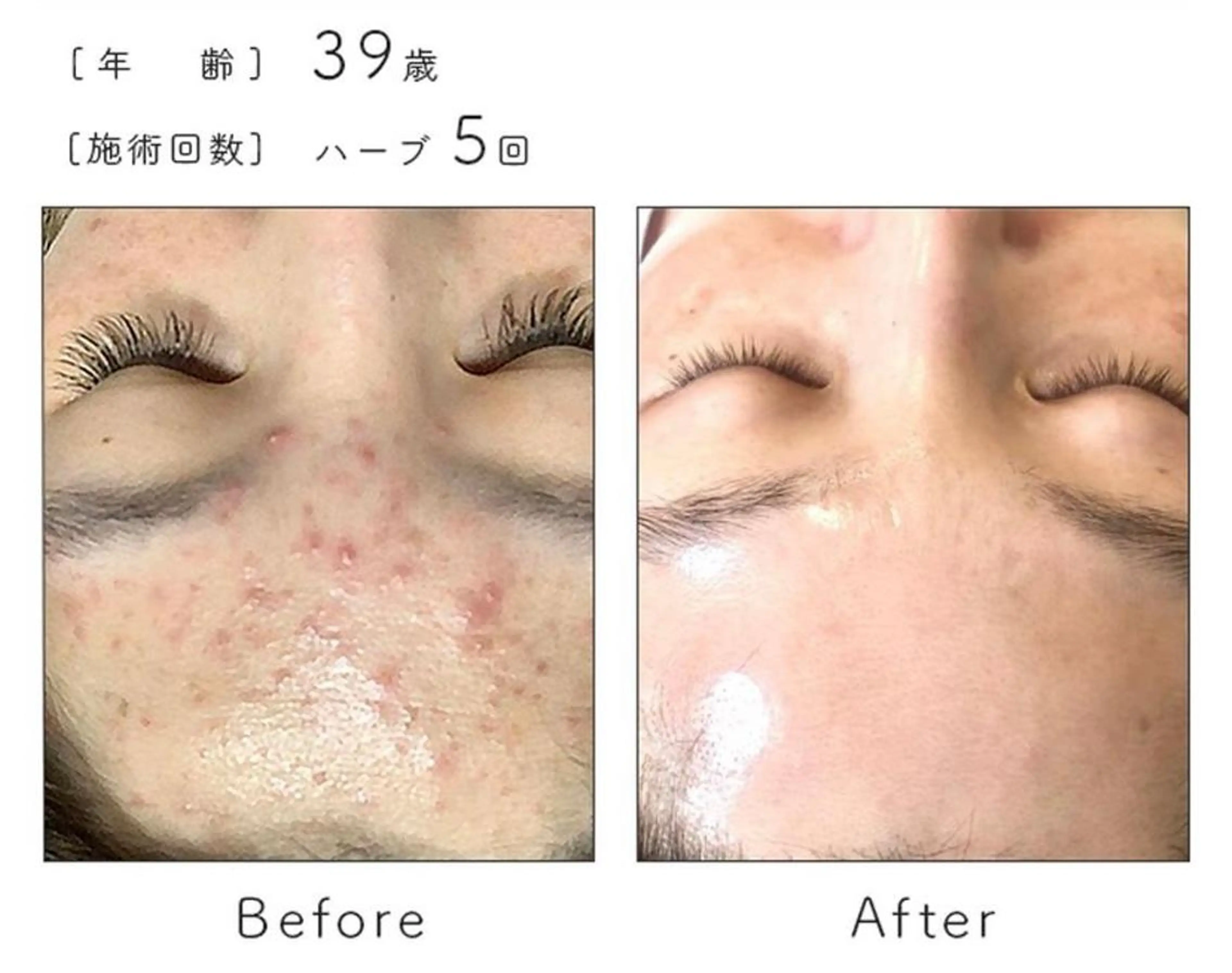 【相談】メニューにお悩みの方！肌カウンセリング🥚⭐️の写真