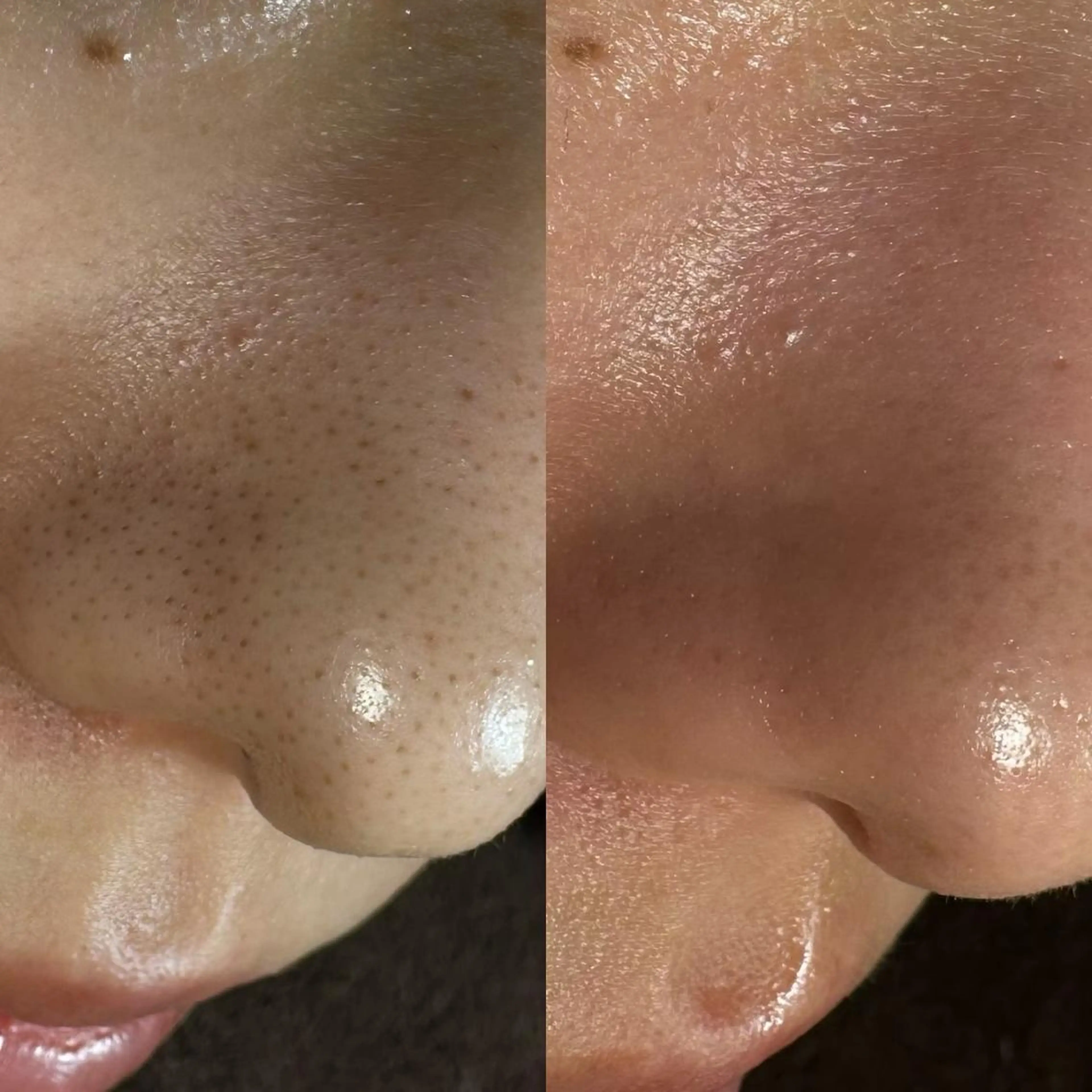 minimo限定★最新★毛穴洗浄フェイシャルエステ肌質改善❤︎オルチャン肌毛穴・黒ずみなしの写真