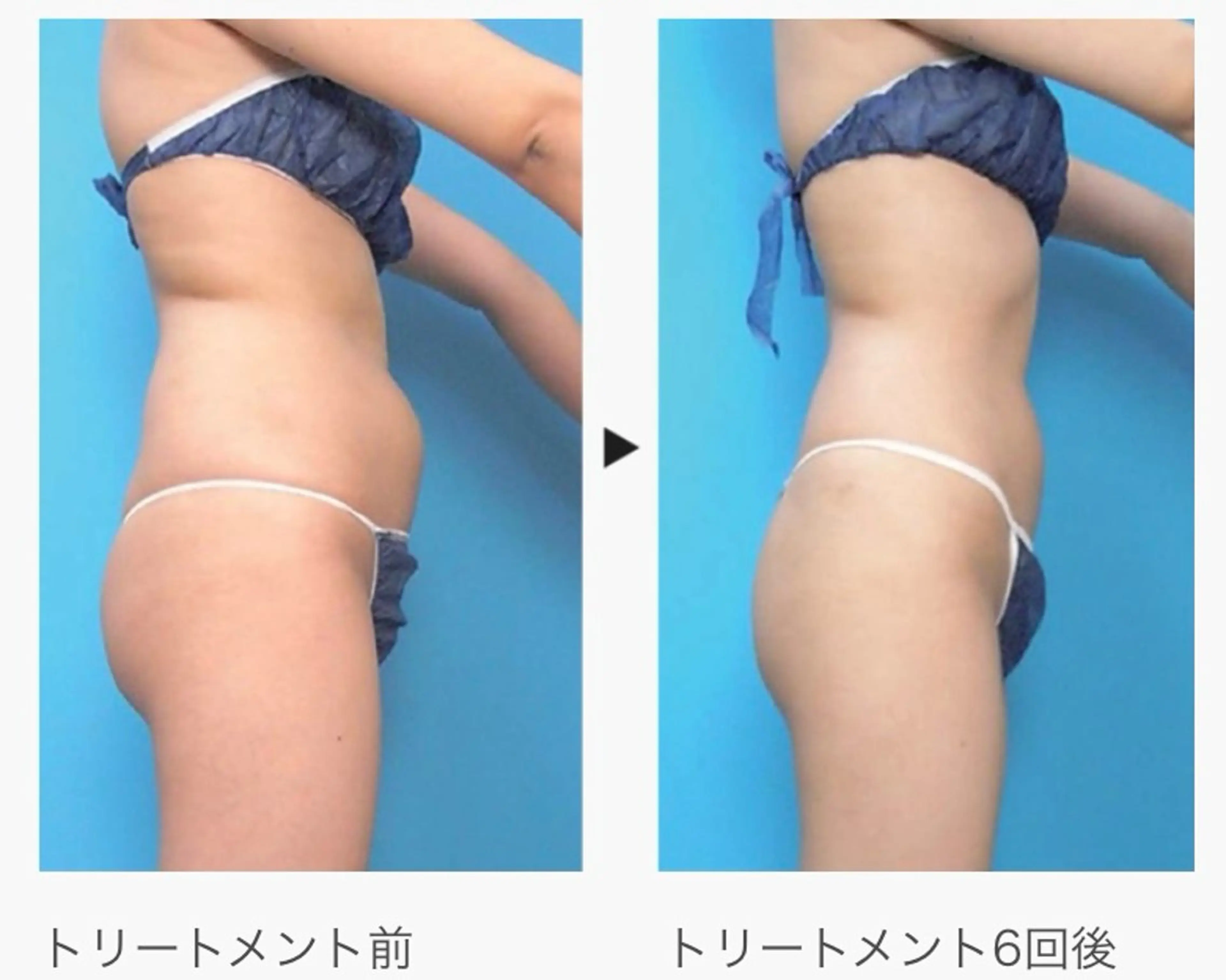 【夏までに楽痩せ】痩身エステ下半身(ヒップから下)コース🫧の写真