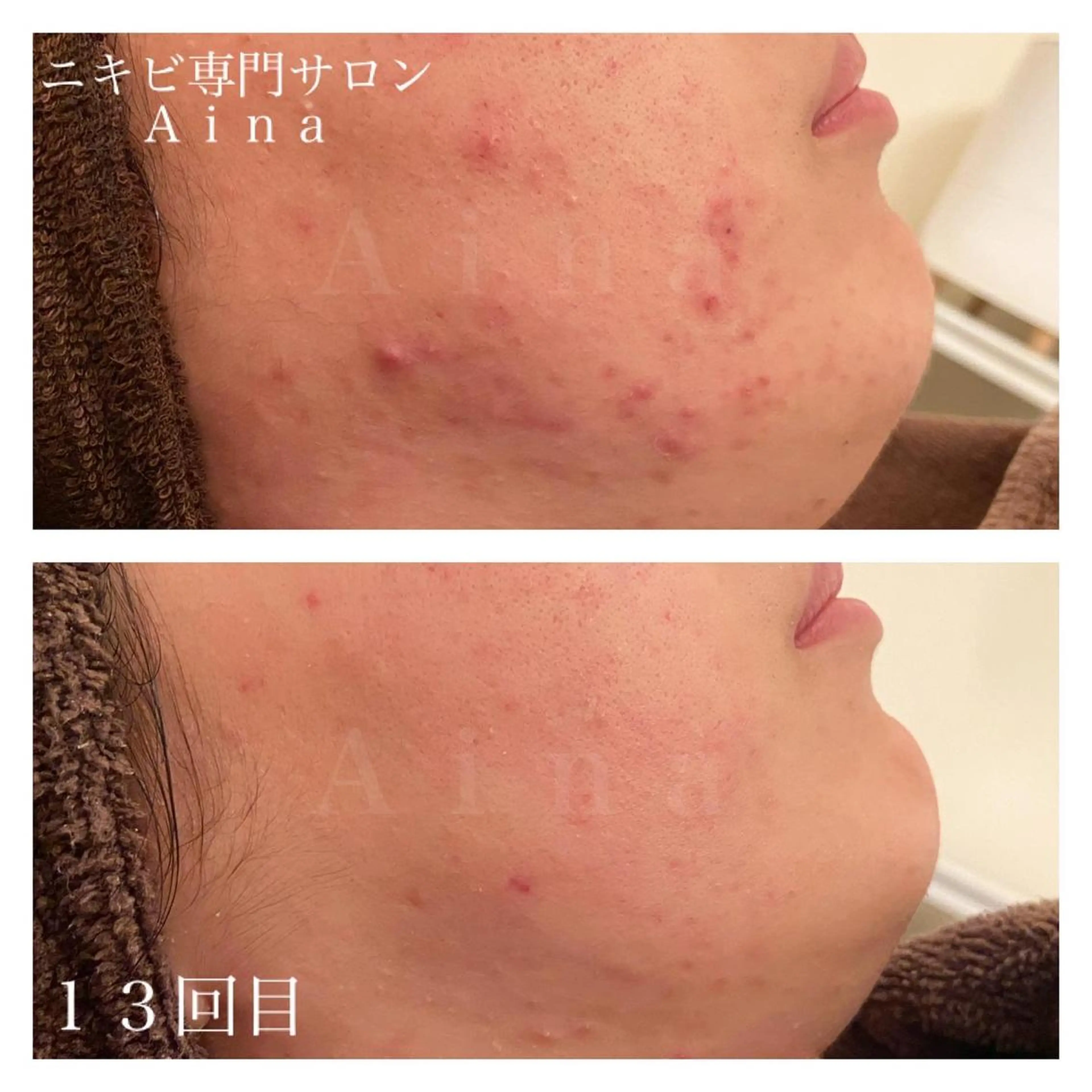 ロング カラー パーマ ヘアアレンジ メンズ キッズ ネイル マツエク・マツパ ニキビ跡専門サロン Ａｉｎａのエステ・リラクイメージ