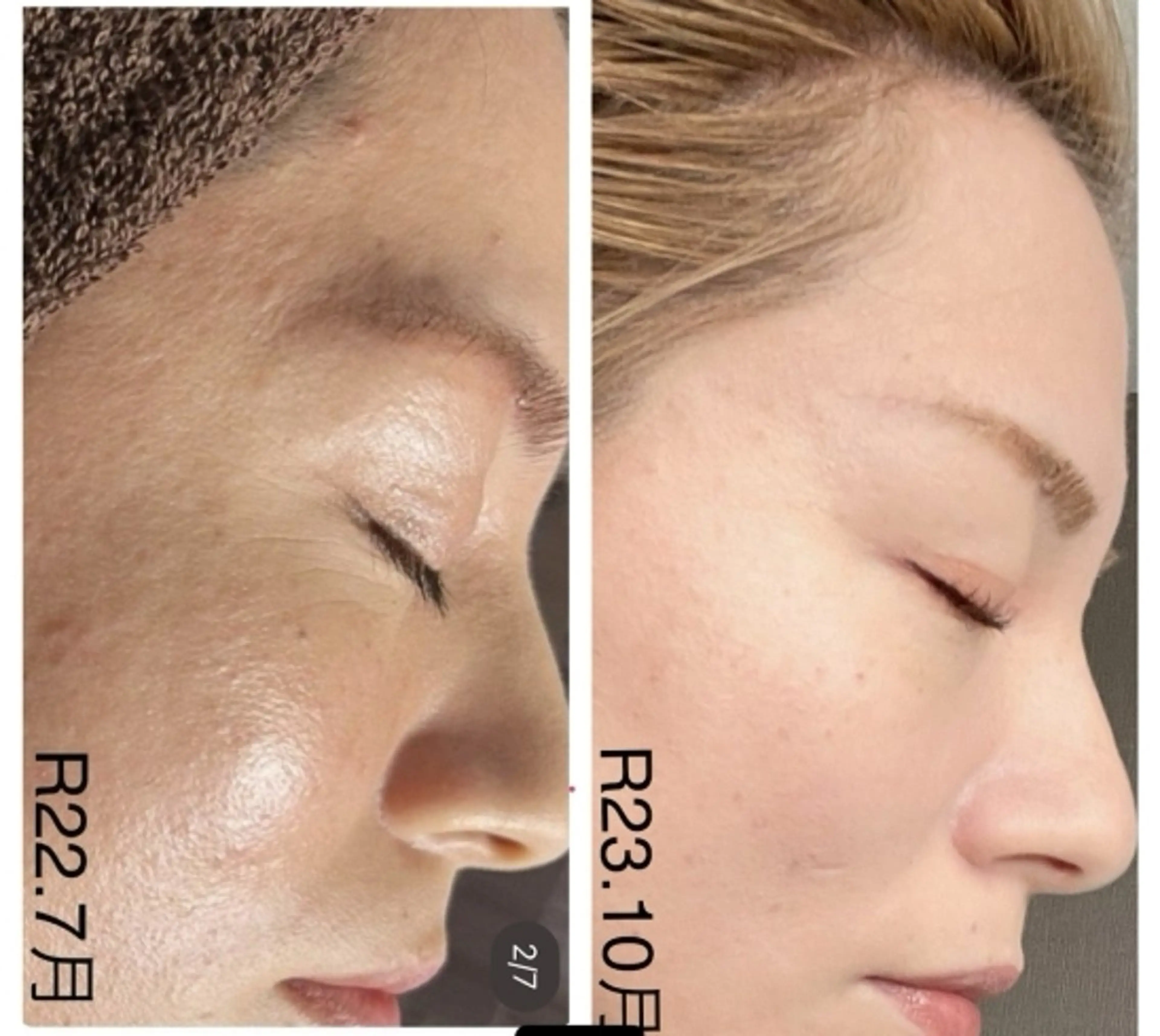 ハーブピーリング専門 毛穴洗浄❤️眉waxのエステ・リラクイメージ