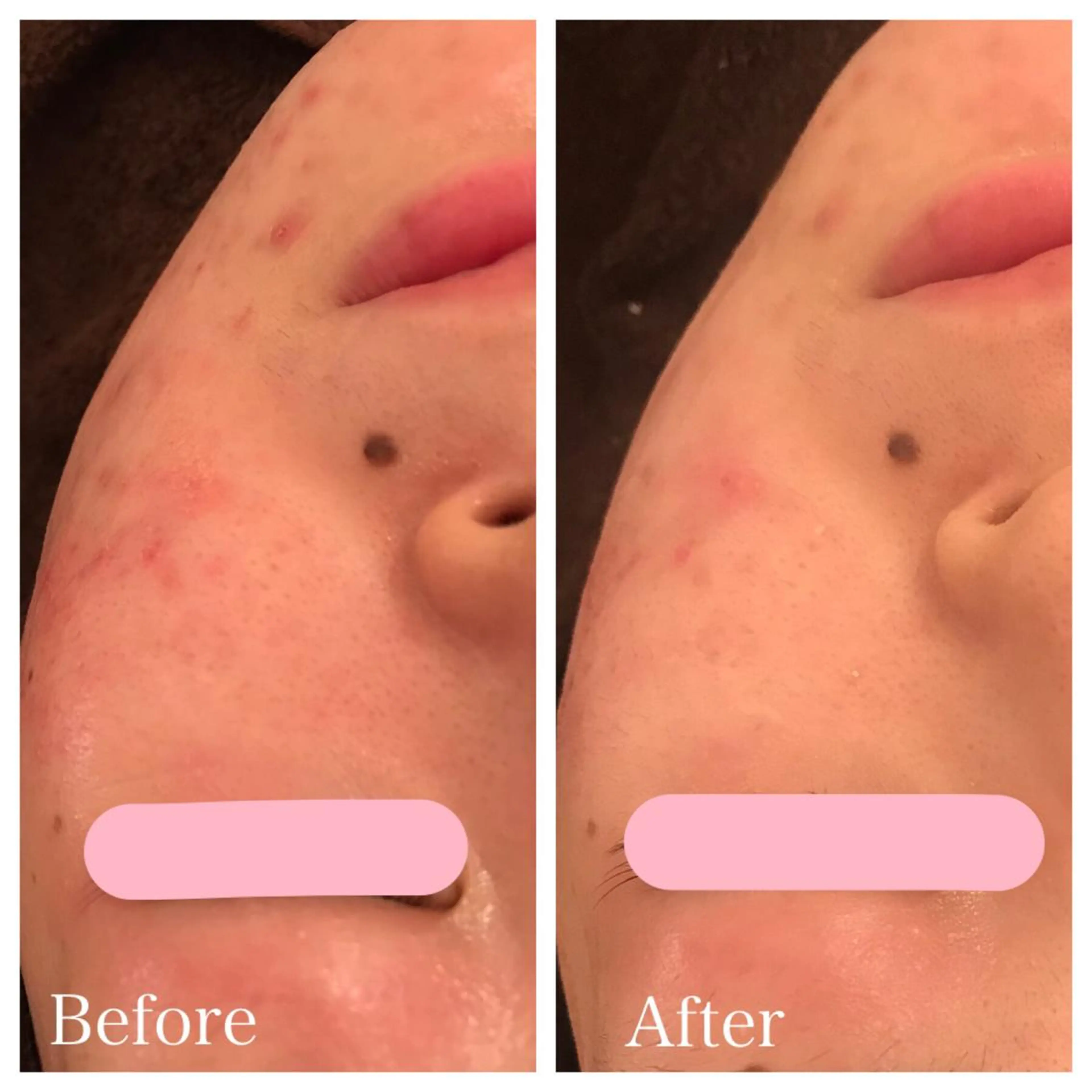 ロング ネイル マツエク・マツパ エステ リラク ニキビ跡専門サロン Ａｉｎａのエステ・リラクイメージ