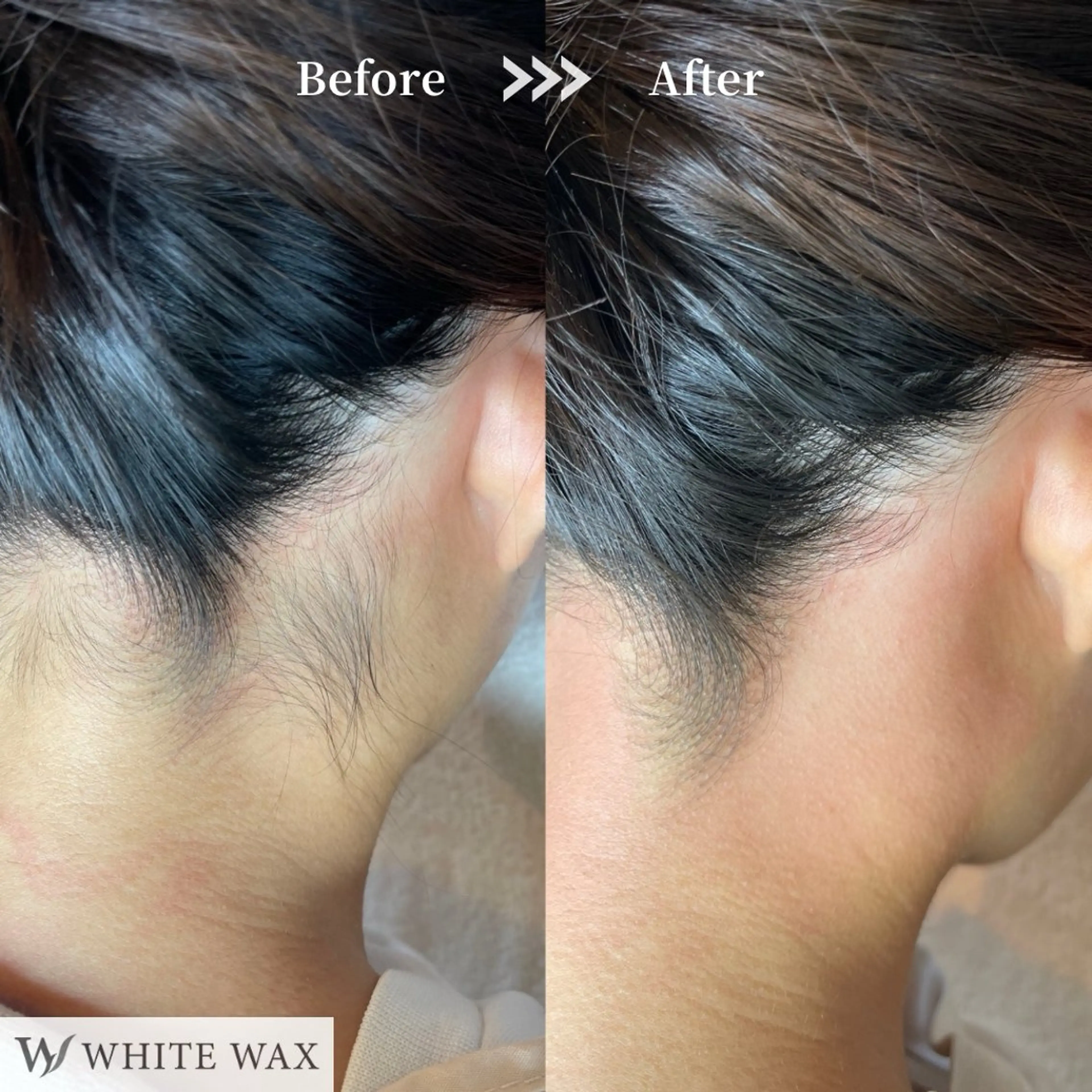 【お得なセット】全顔ワックス＋うなじ・首後ろワックスの写真