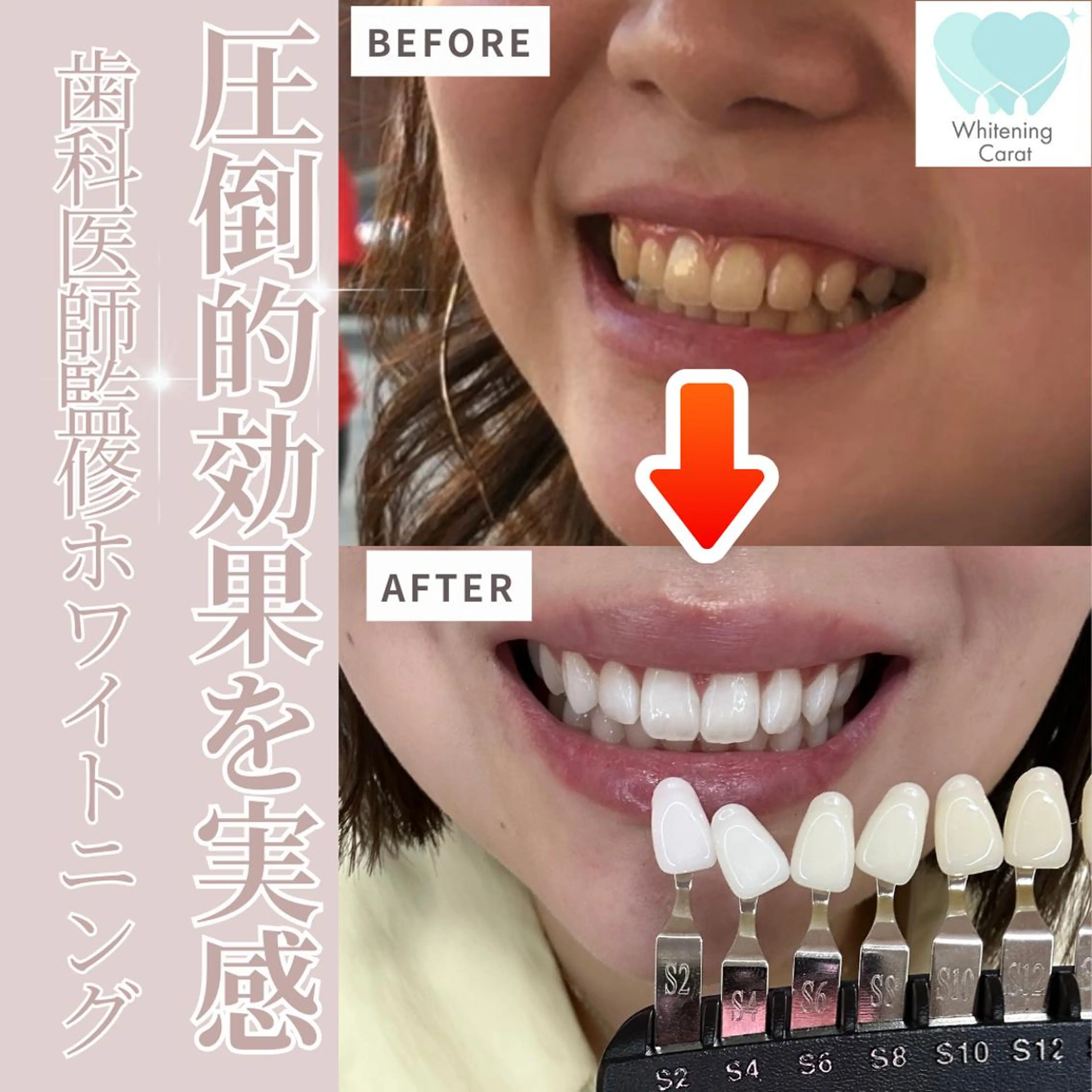 【初回限定】通常5,500円→2,490円で提供🦷LEDライト15分照射×1回🫶55%オフの大サービス📴の写真