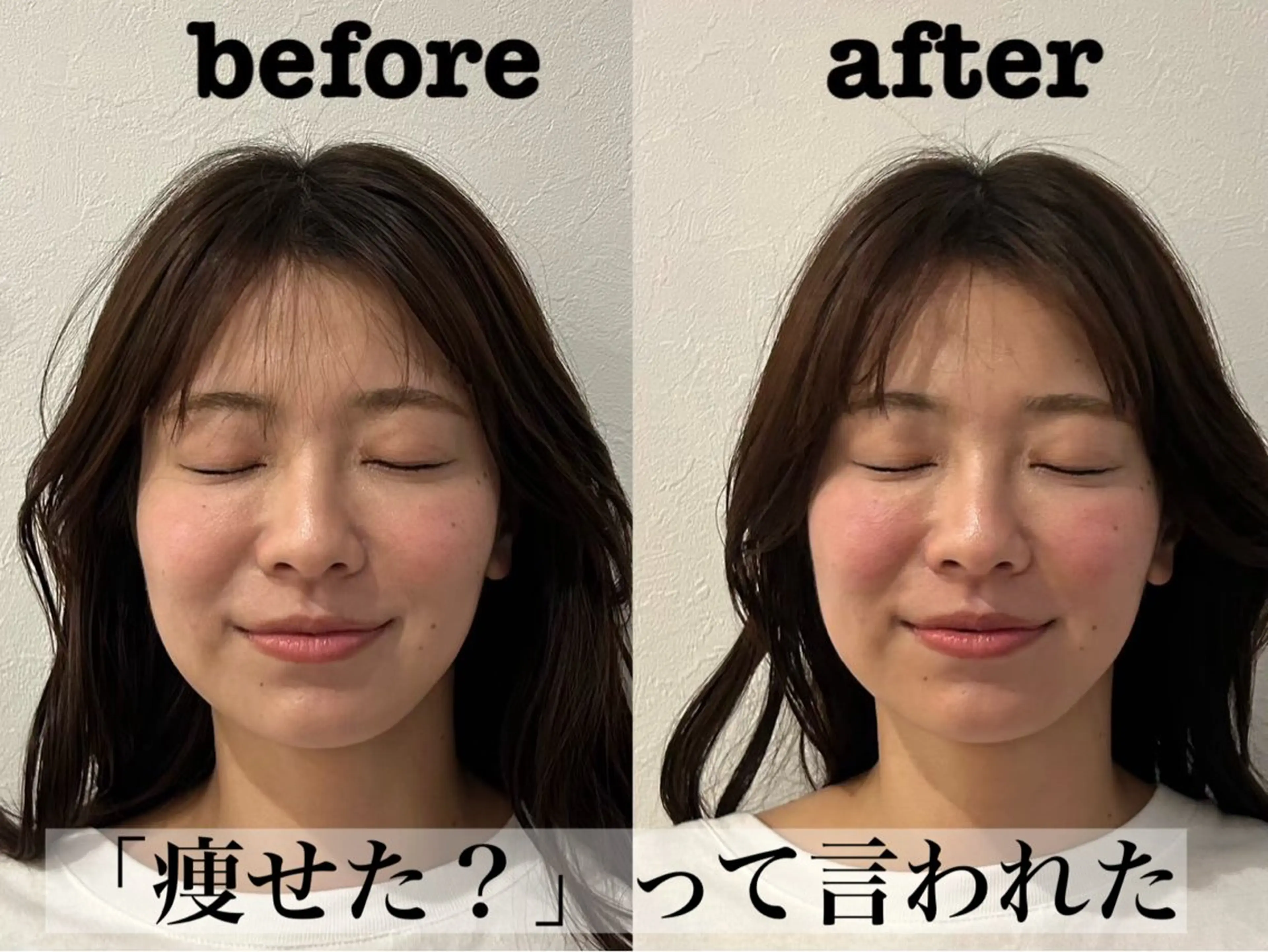 エステ リラク 肌質改善×美容鍼 ゆいのエステ・リラクイメージ