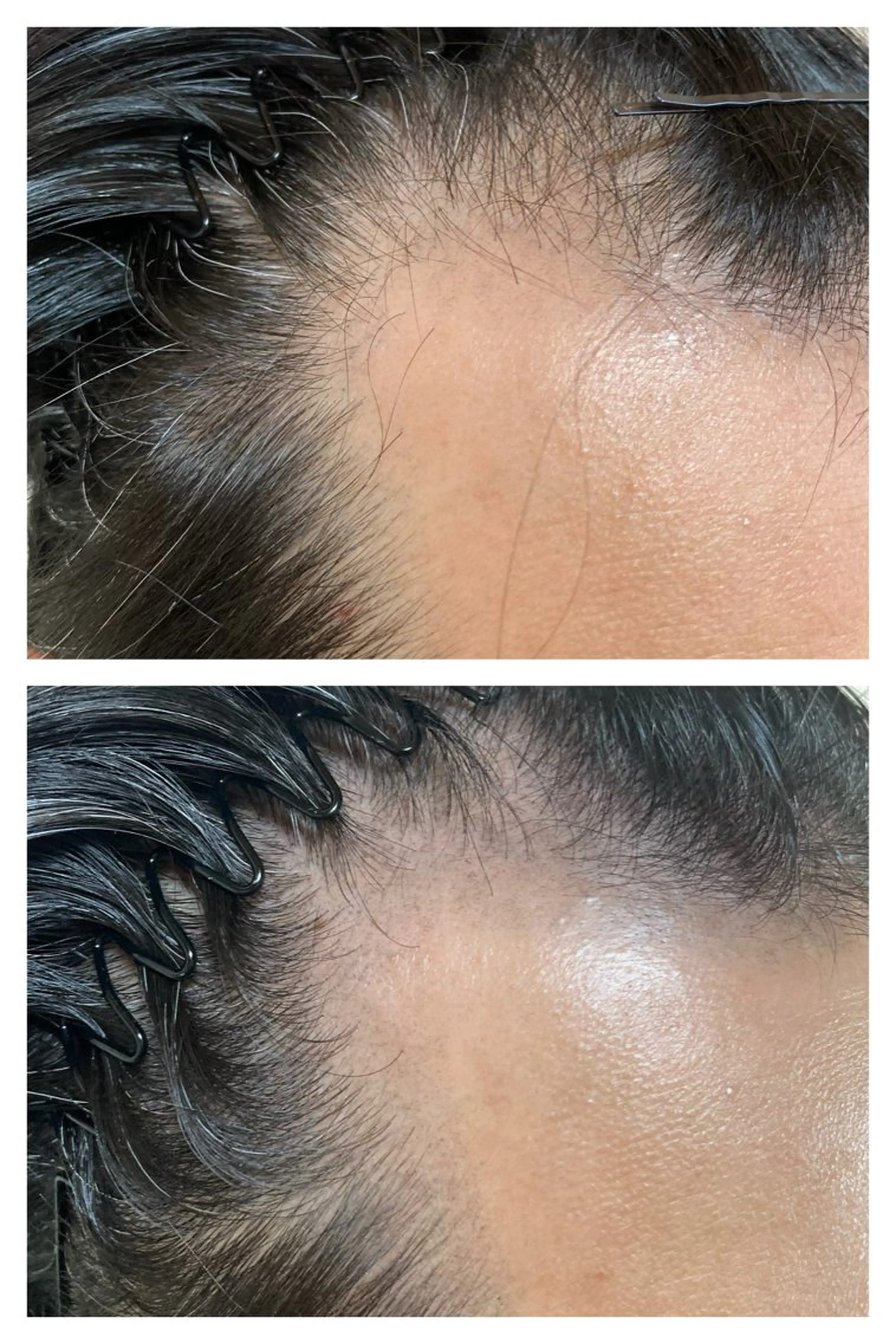 スカルプインク50000発⭐️モニター価格⭐️の写真