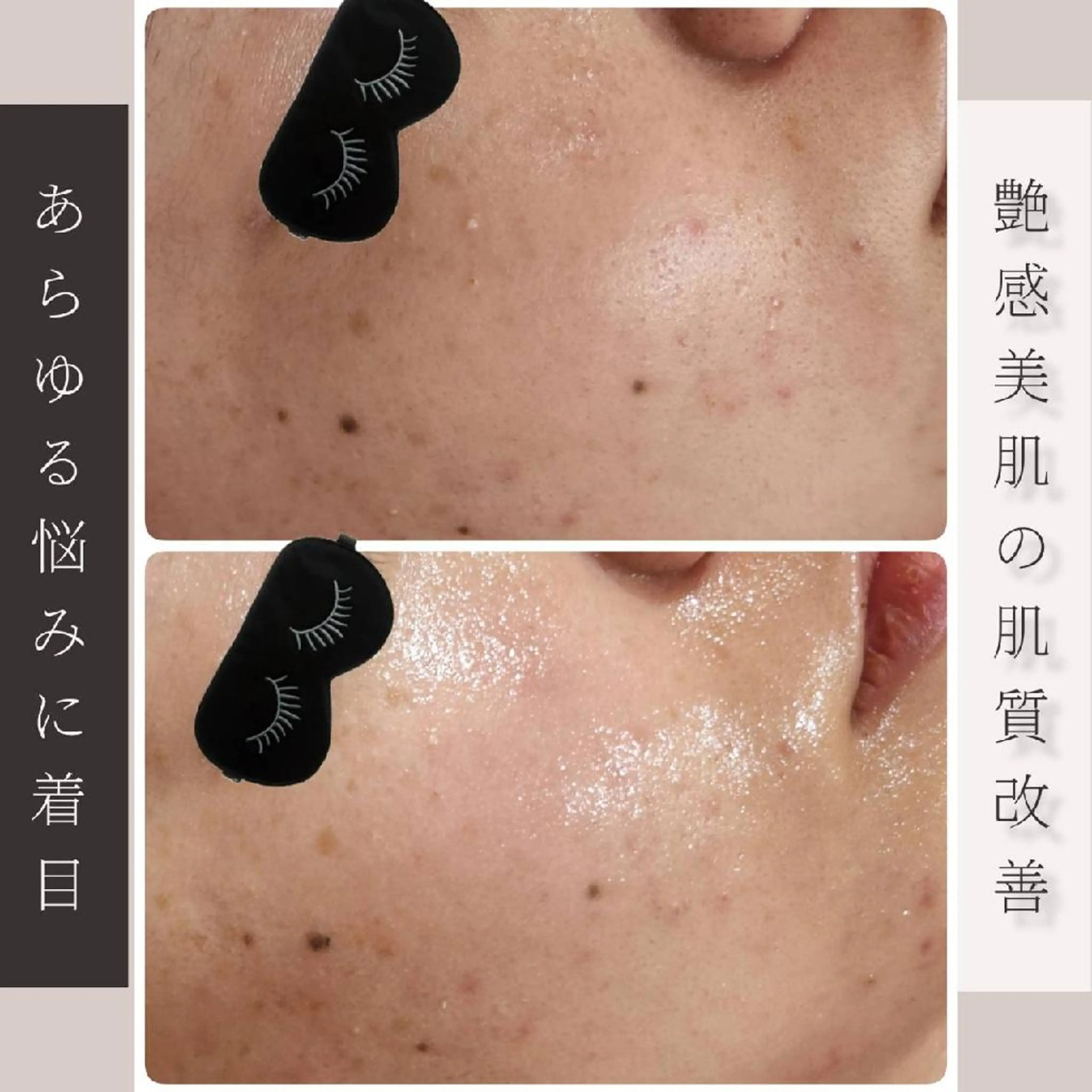 【凹凸肌/ニキビケア/エイジングケア】ハーブピーリングダブル+ポレーションの写真