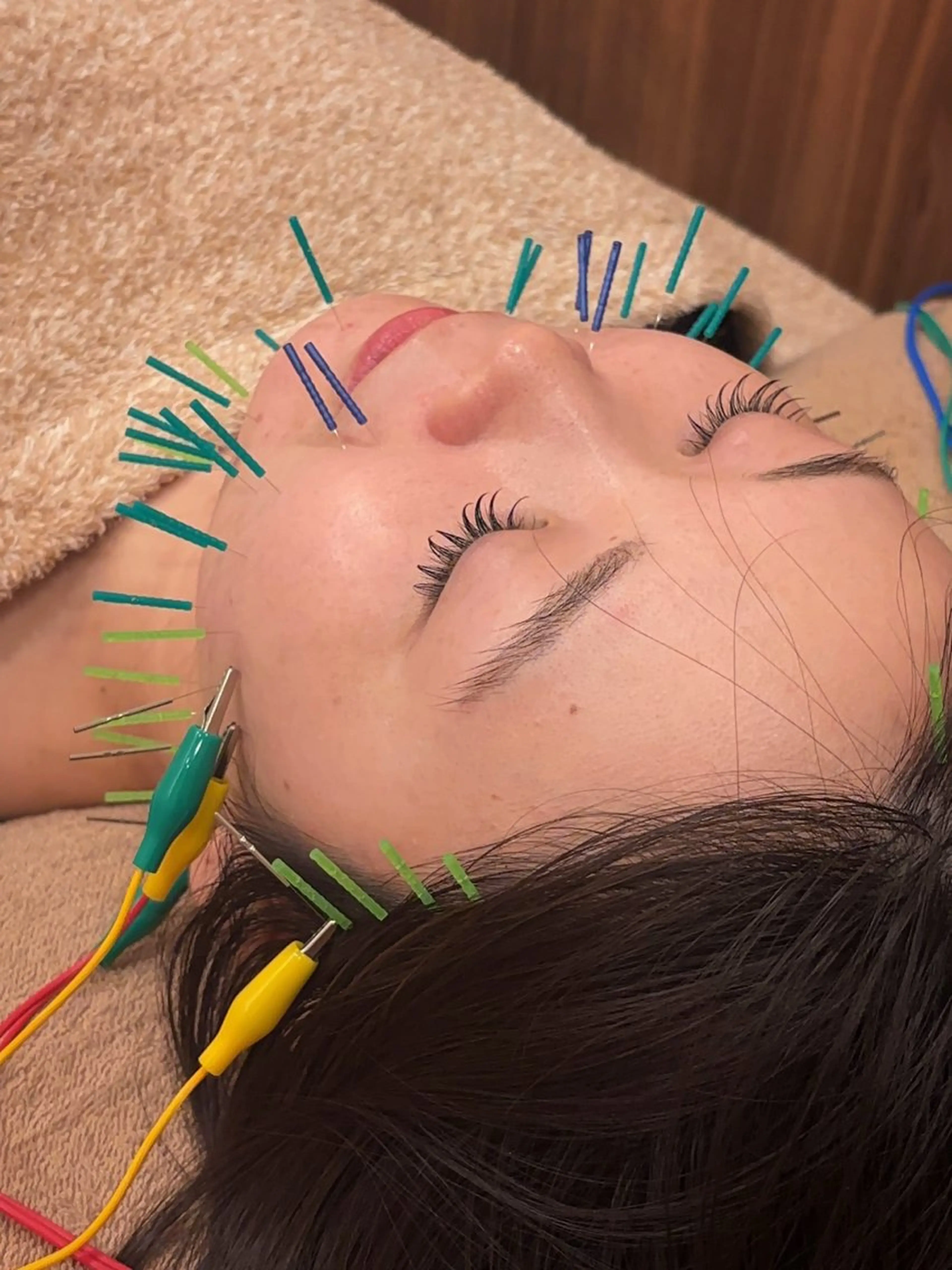 美容鍼50本🪡＋小顔マッサージ＋保湿仕上げの写真
