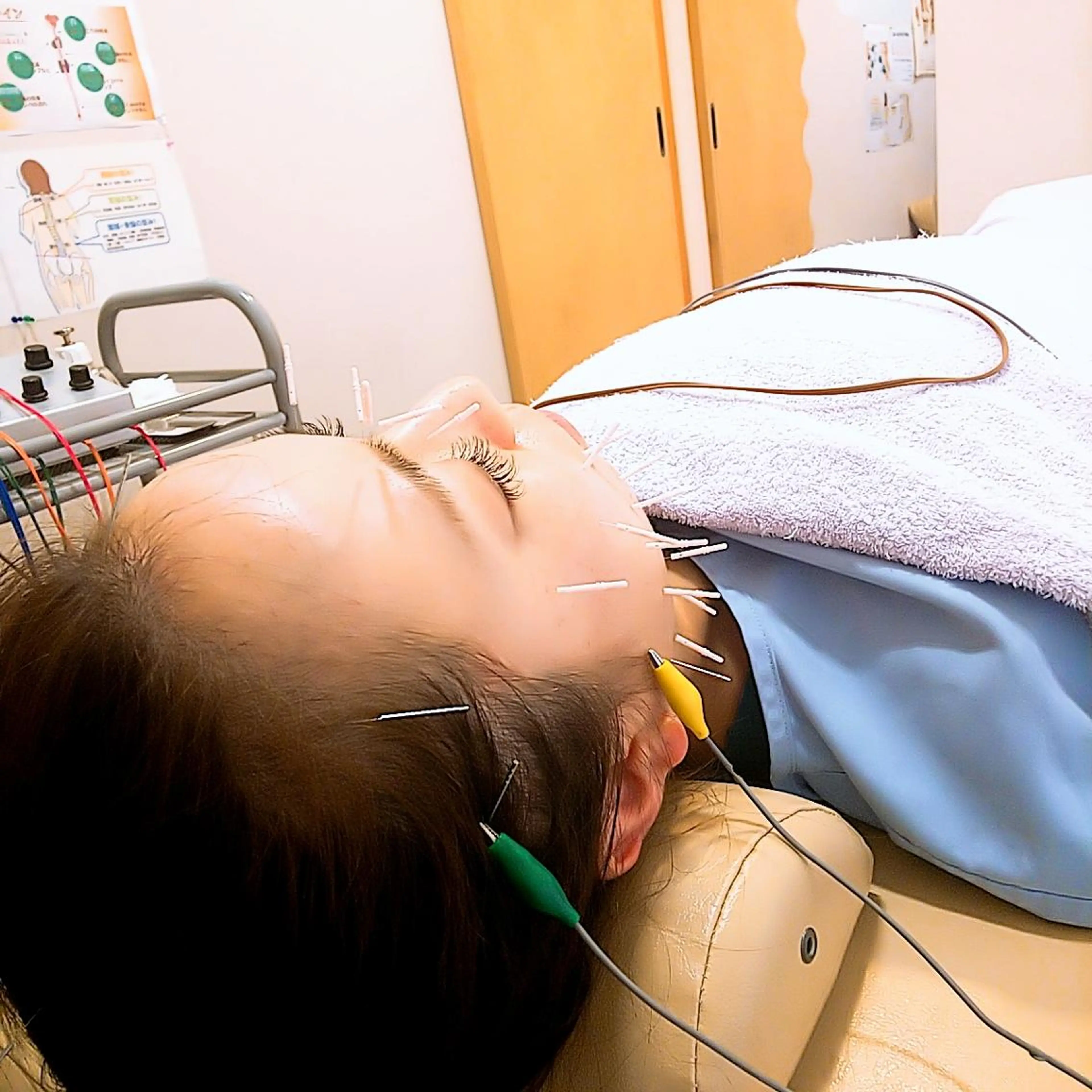 リフトアップ・たるみ ☆美容鍼小顔矯正のその他イメージ