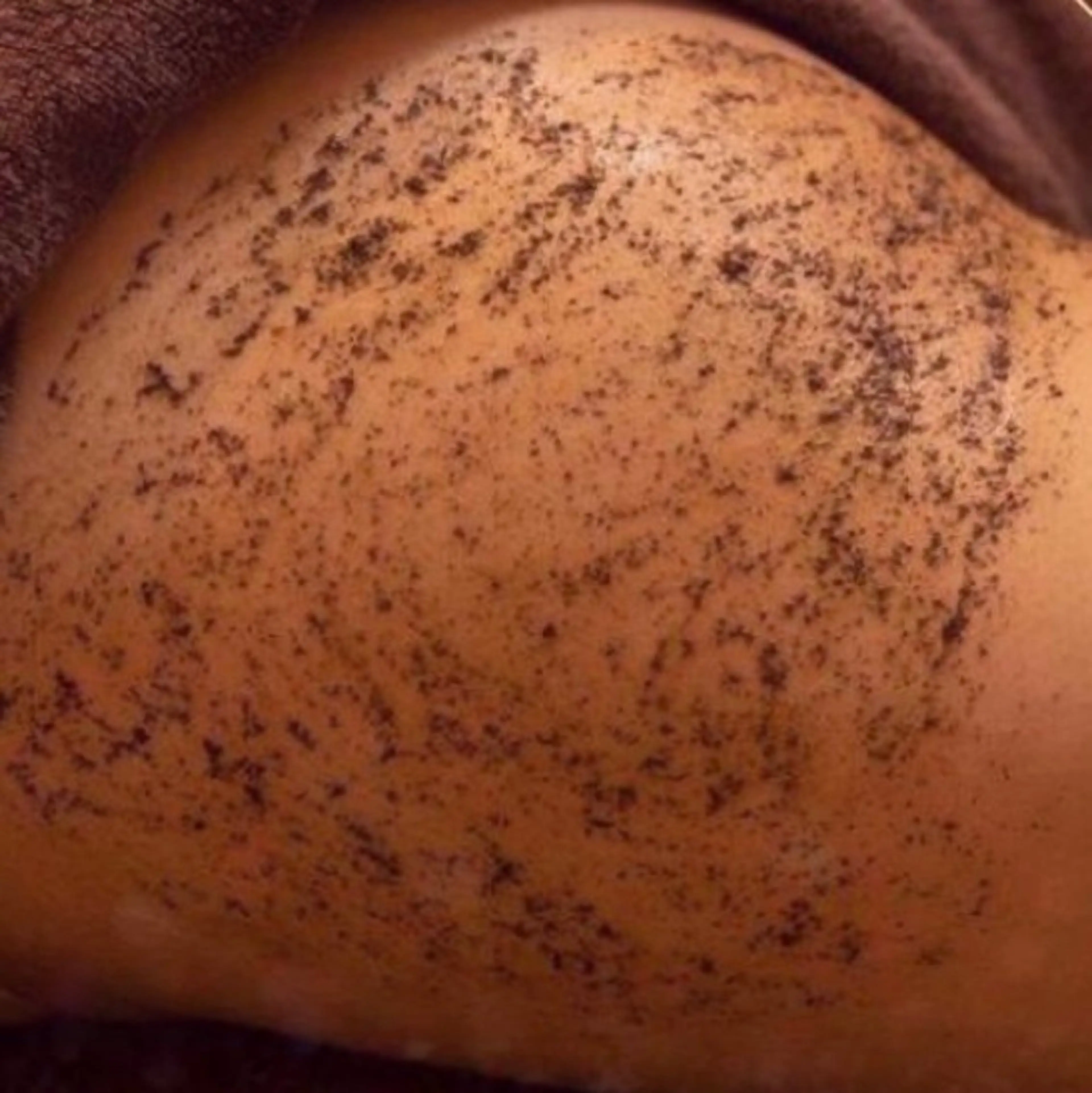 お尻 🍑 REVIハーブピーリング《陶肌トリートメント》  / ブツブツ・カサカサ・黒ずみ改善。釘付けの美尻へ！の写真