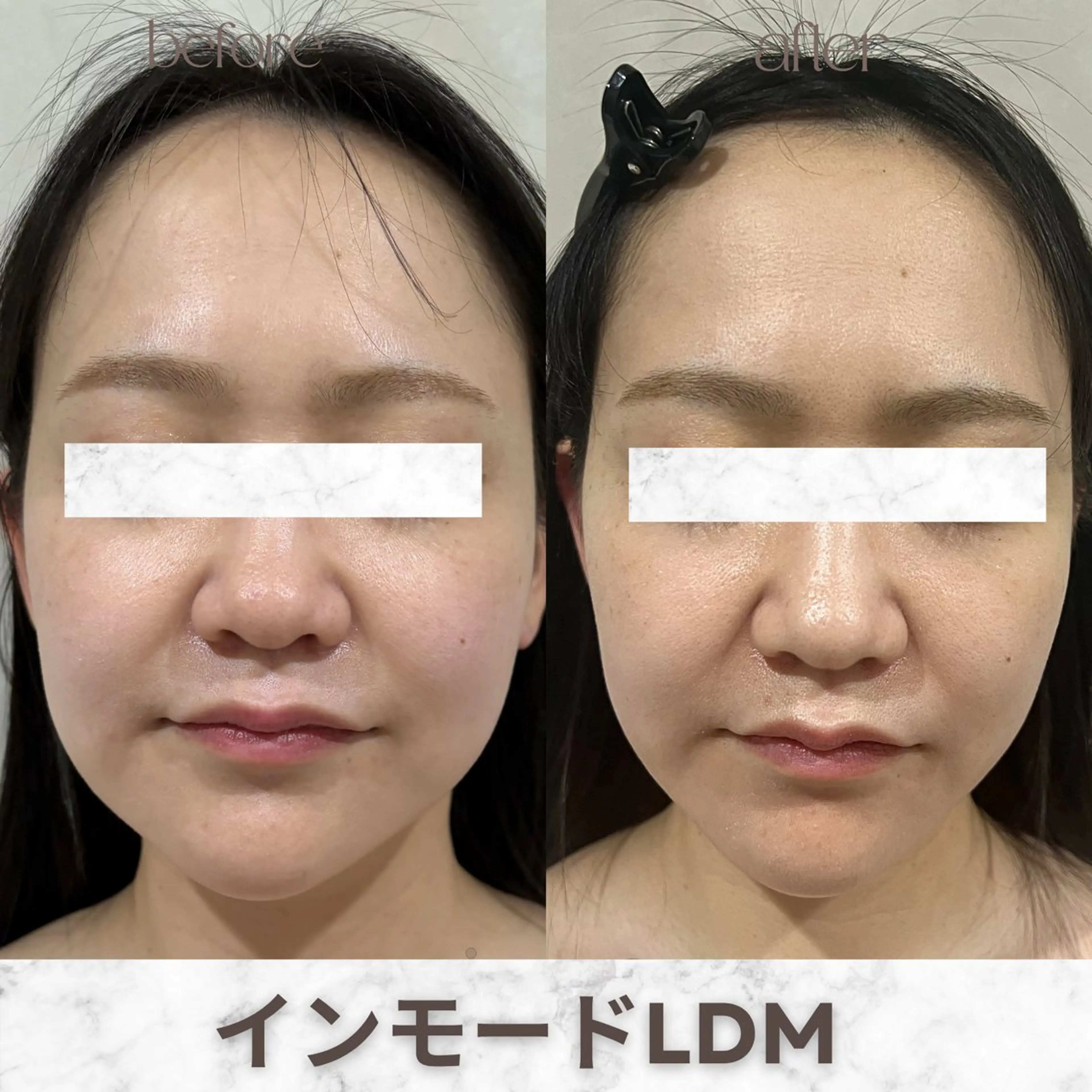 エステ aimer服部 /  小顔 ・ 痩身のその他イメージ