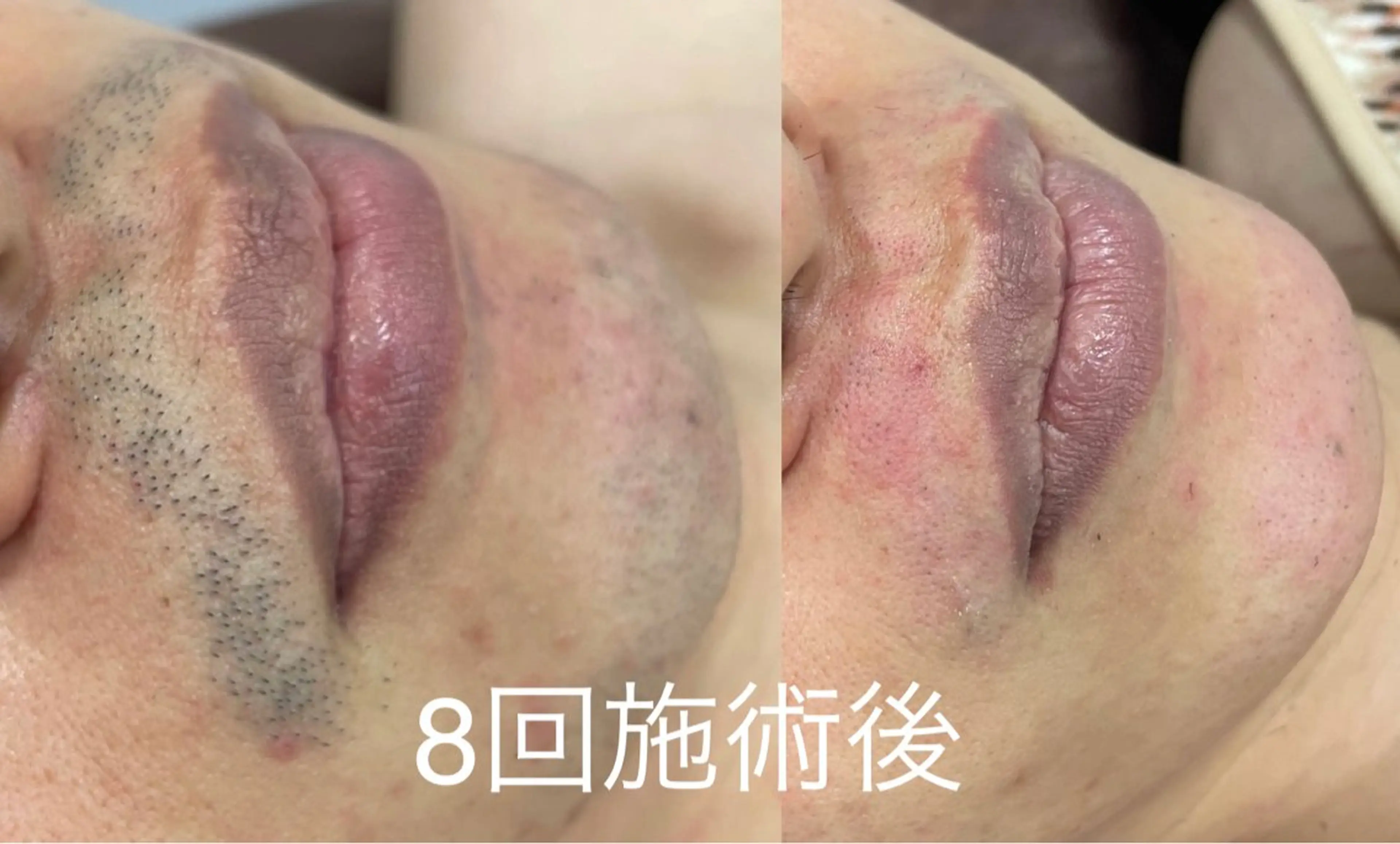 大阪脱毛|ちぇるま| 眉毛Wax｜美肌管理のエステ・リラクイメージ