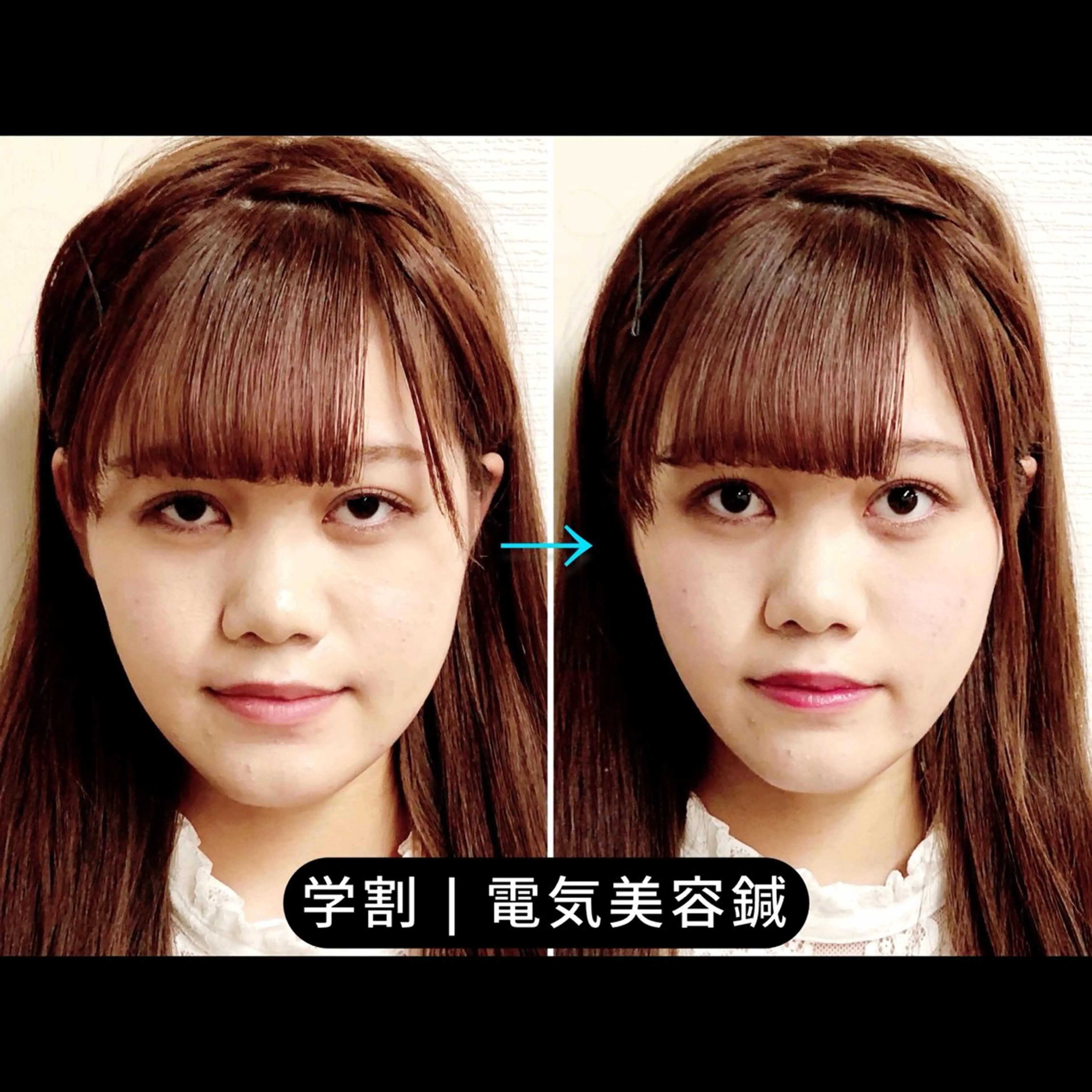 【ミニモ学割U24】イベント前のむくみOFF！小顔美容鍼×EMSの写真