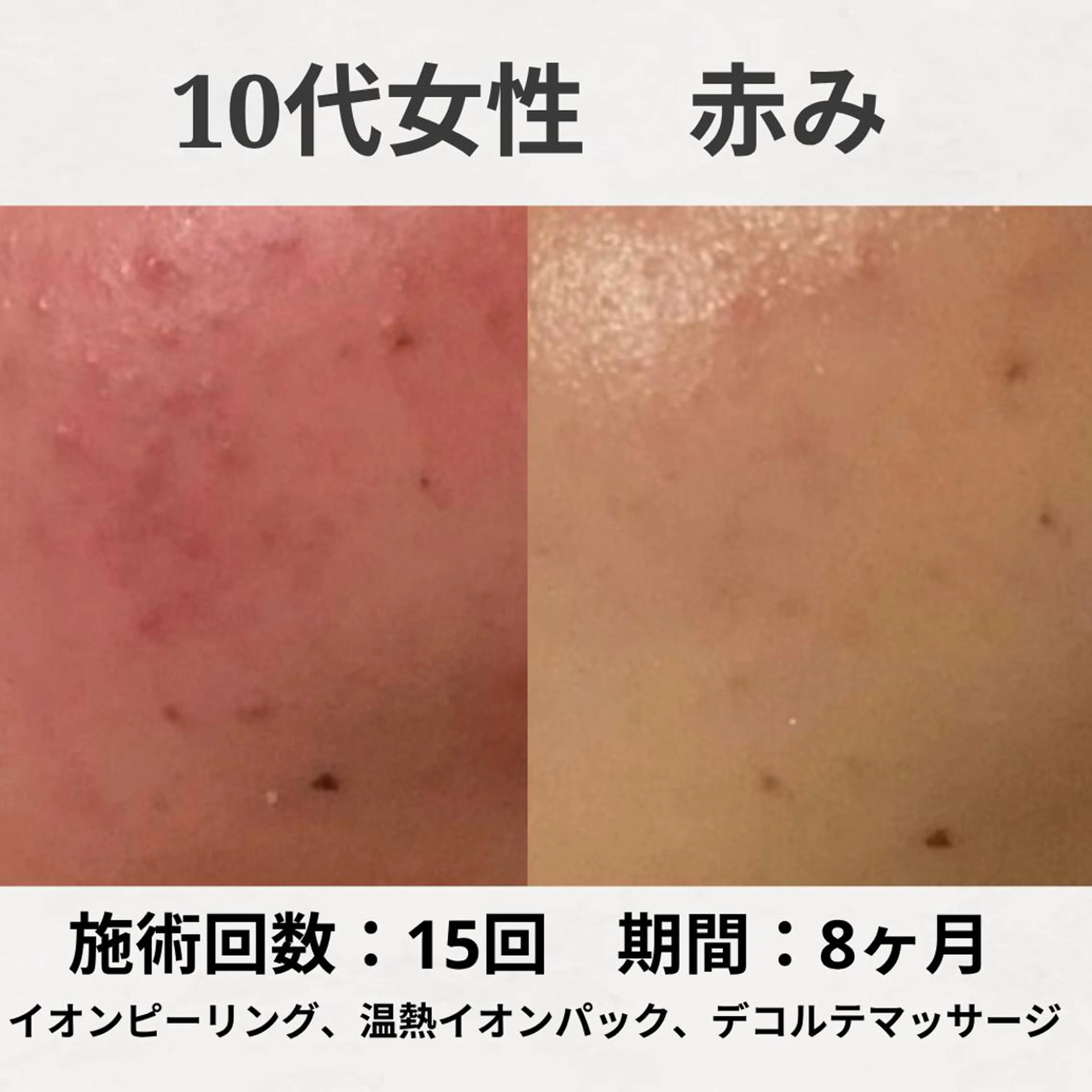 エステ リラク ニキビ跡改善専門🔥 医療にはできない改善のエステ・リラクイメージ