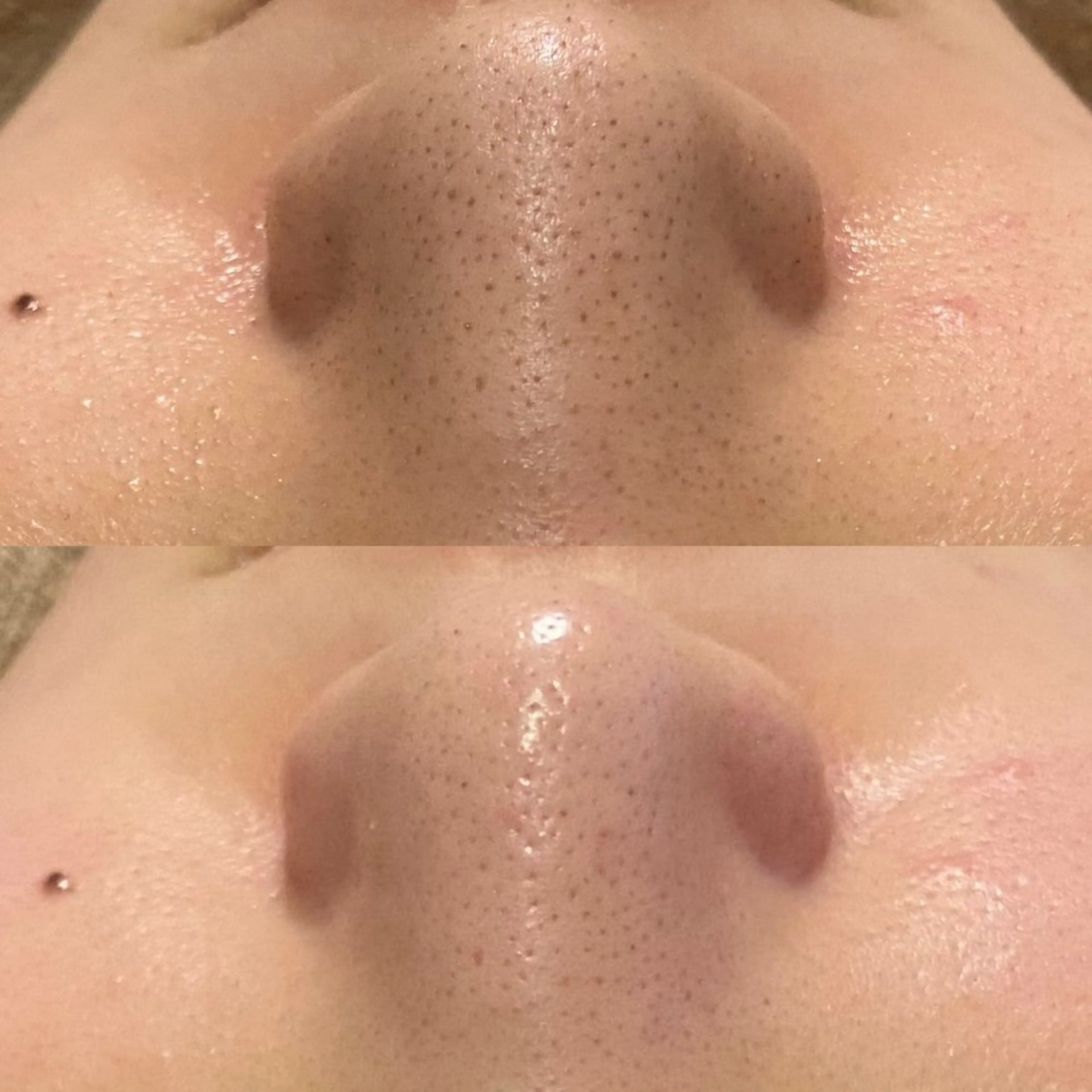 ☆肌質改善コース☆角質除去+ハイドロ毛穴洗浄+ポレーション美容導入+パックの写真