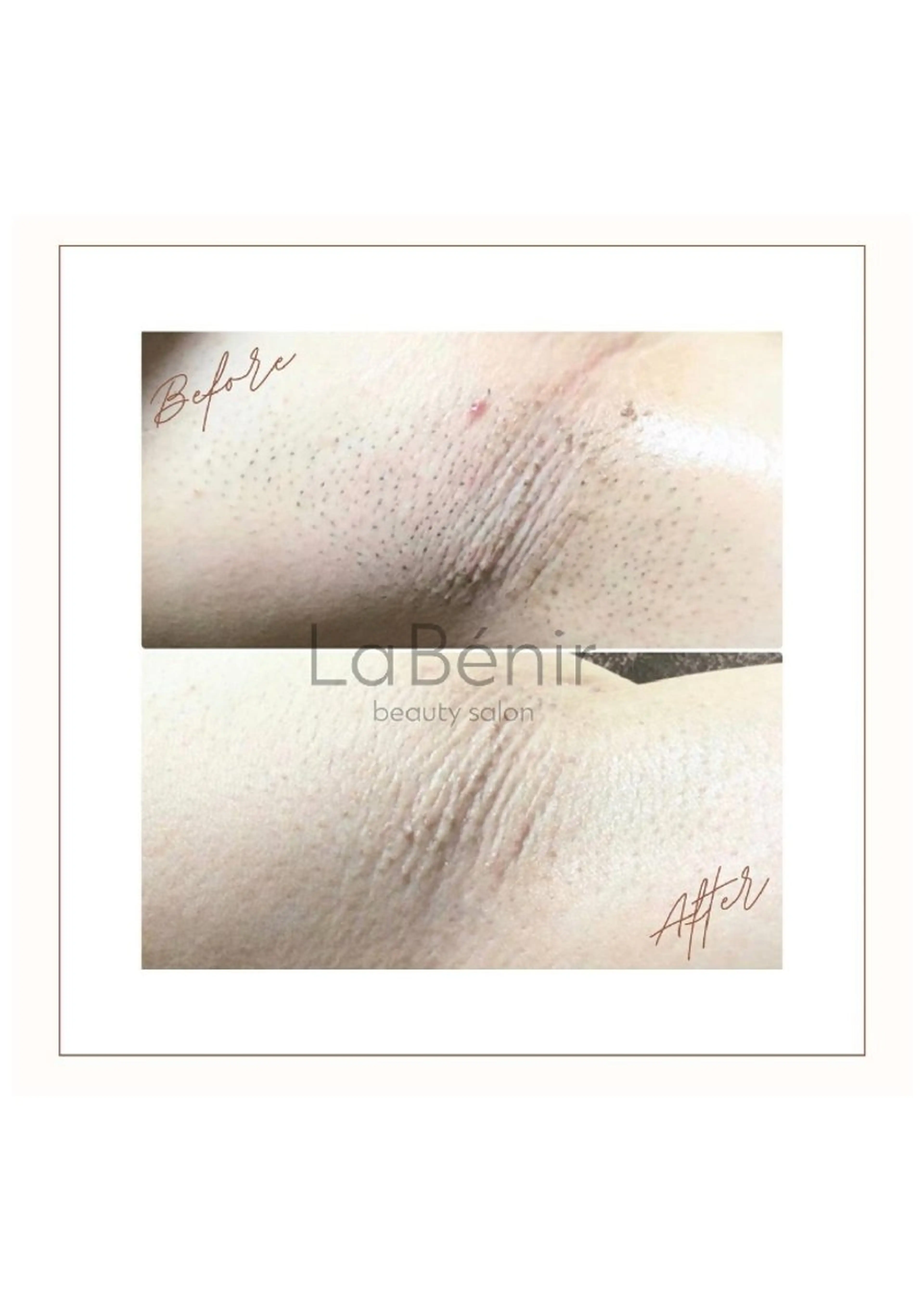 脱毛 脱毛/美肌【皮膚科看 護師経営】ラベニールのエステ・リラクイメージ