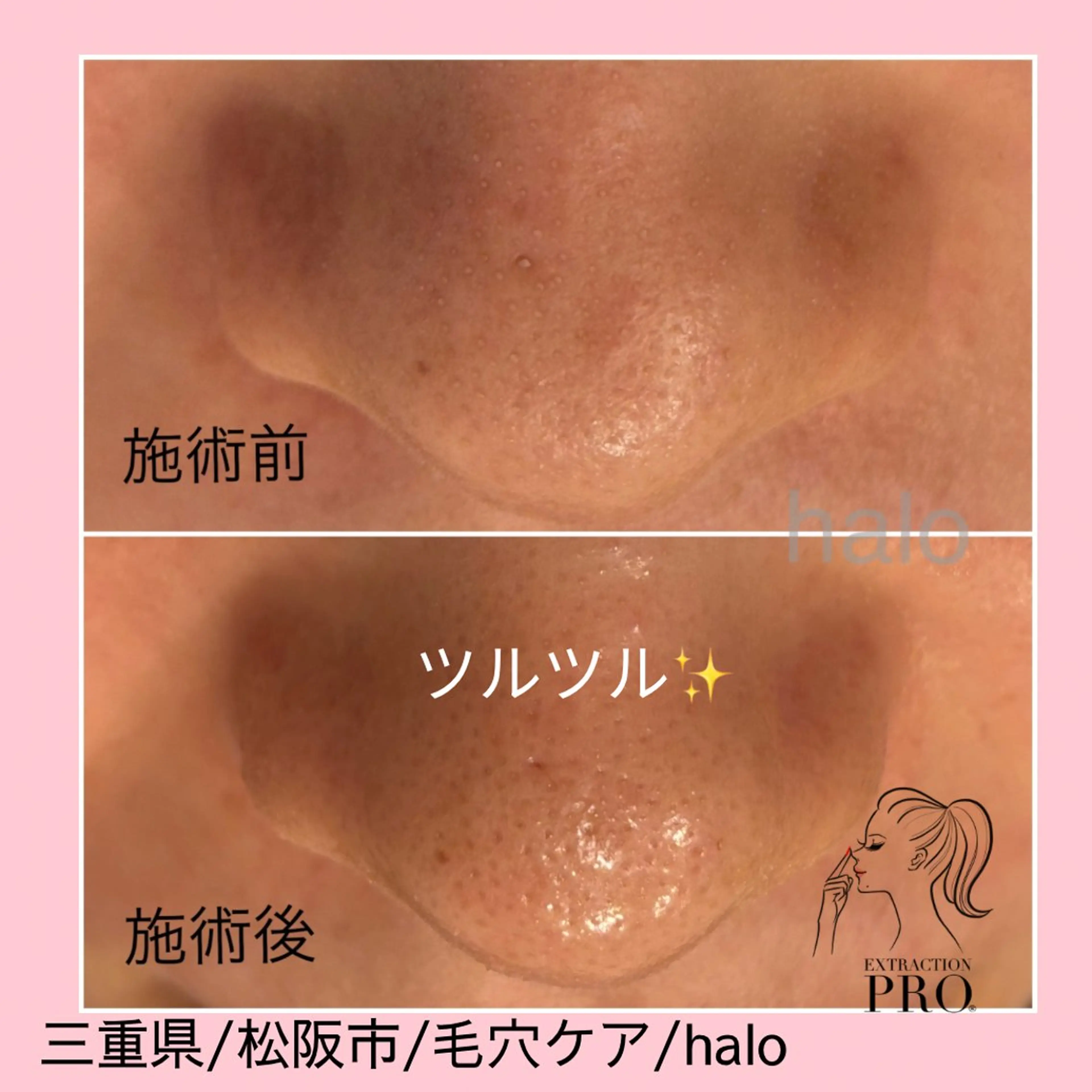 毛穴エクストラクションプロ「毛穴美人コース」Open記念価格の写真