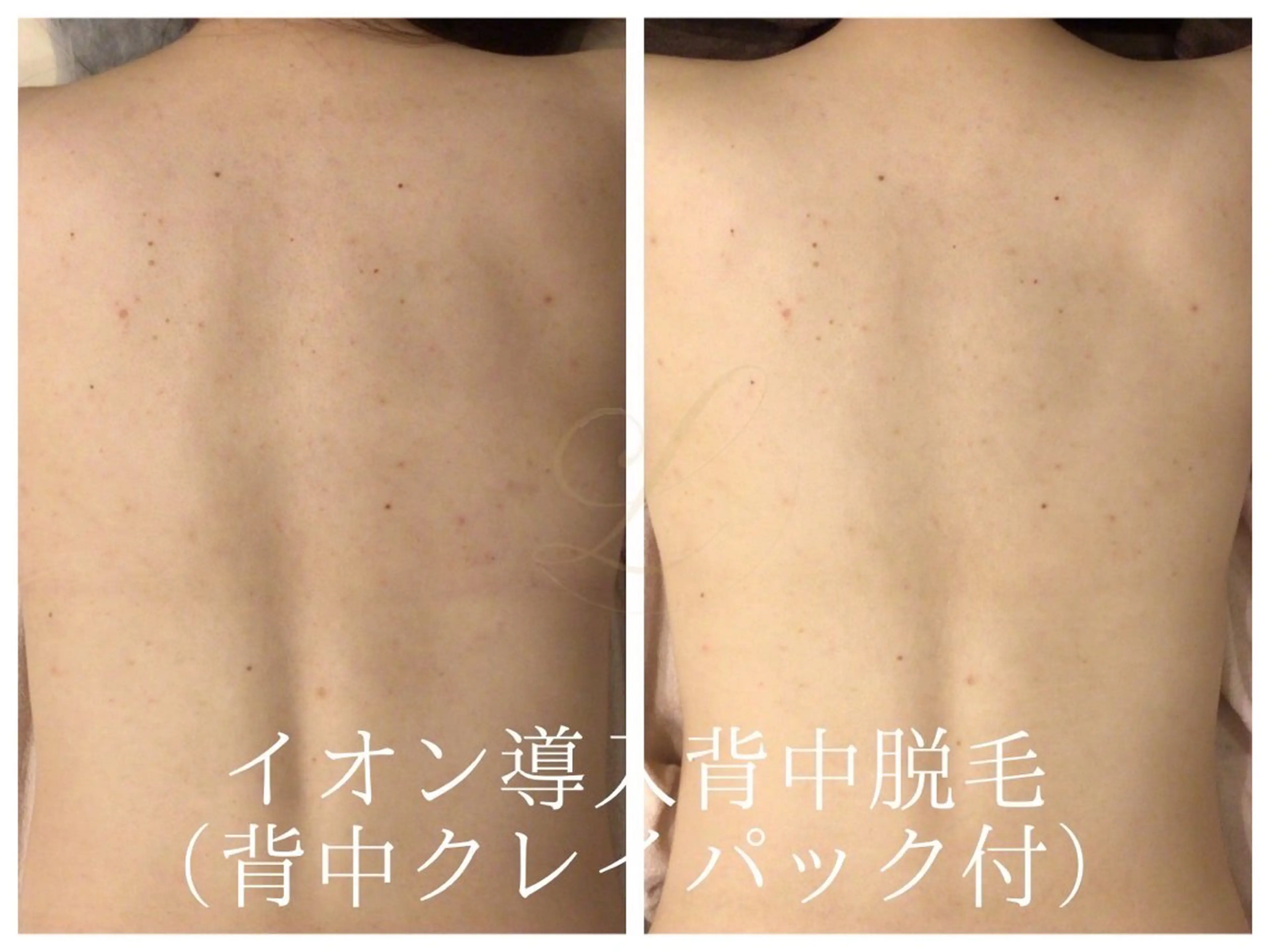 脱毛 🎀うなじ脱毛🎀 ㅣLino堀江のエステ・リラクイメージ