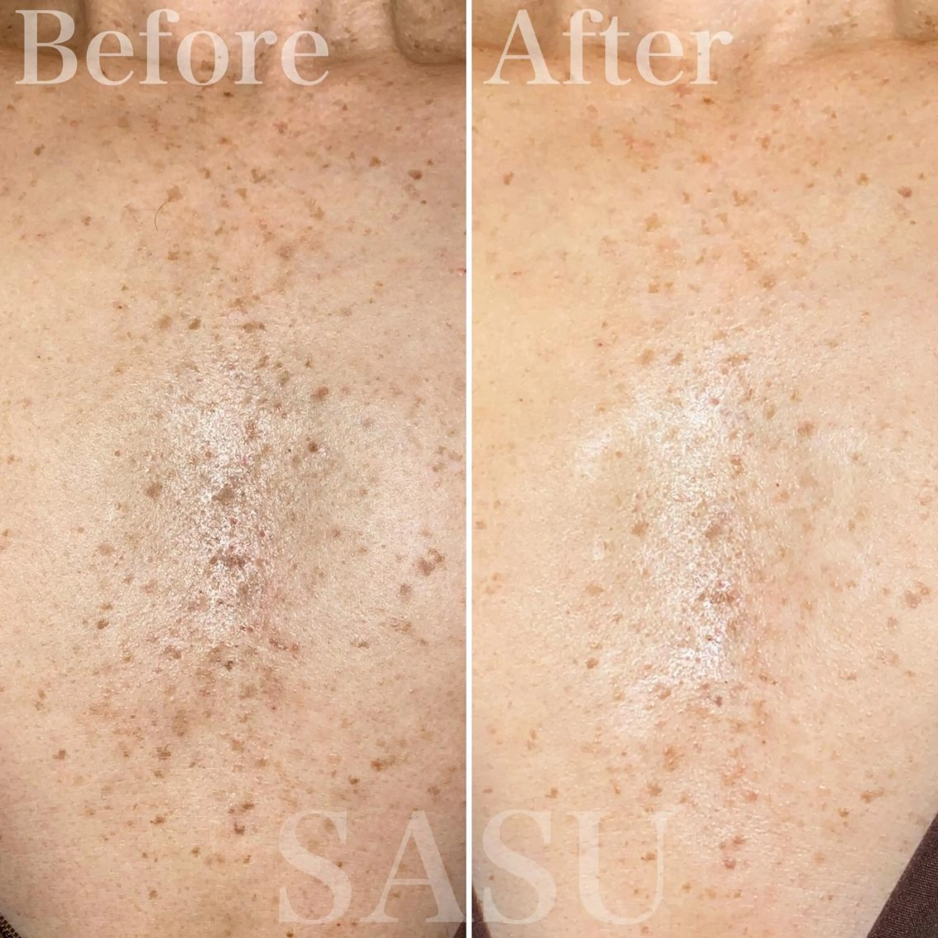 メンズ 即小顔♥️美容鍼× ハーブピーリングのその他イメージ