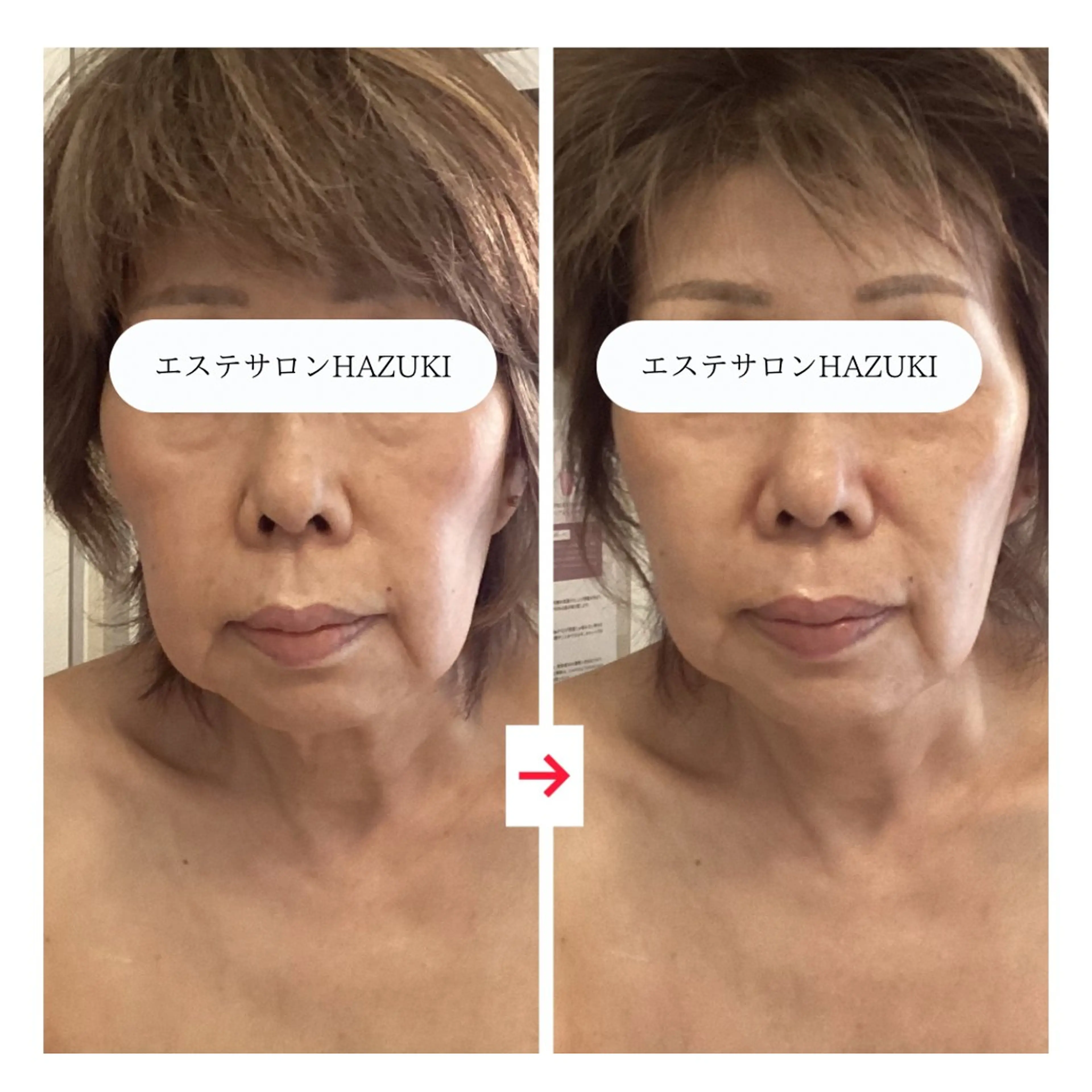 その他 たるみ改善小顔エステ 堀葉月のその他イメージ